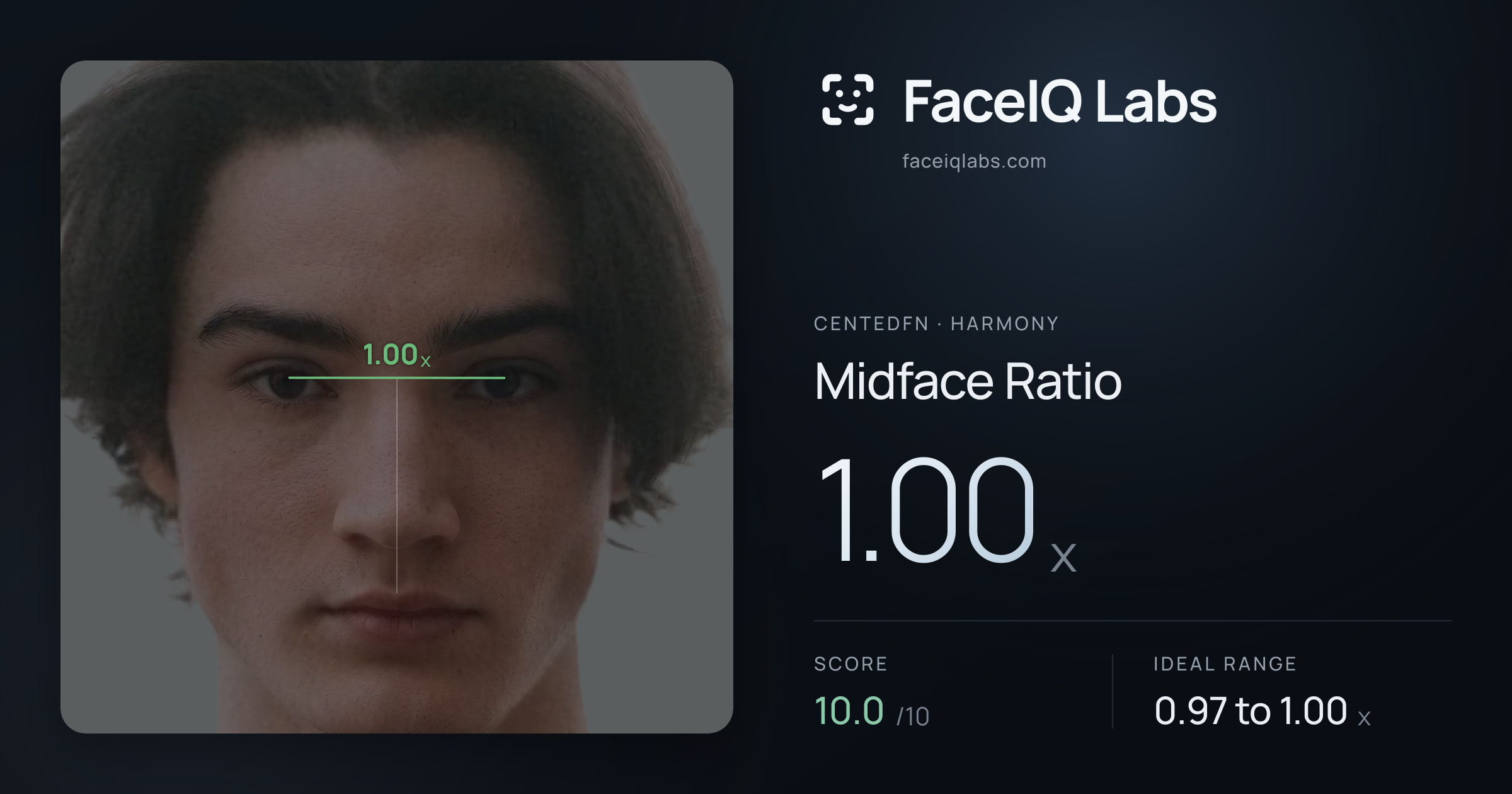 CentedFN Midface Ratio: 1.00x, drawn on the photo
