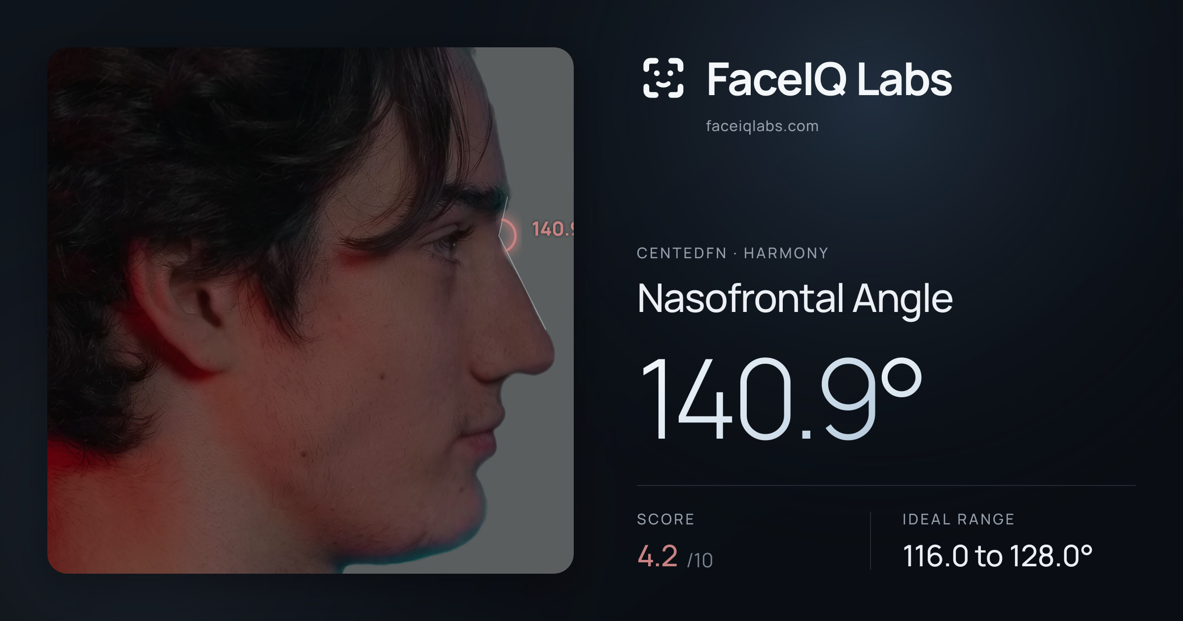 CentedFN Nasofrontal Angle: 140.9°, drawn on the photo