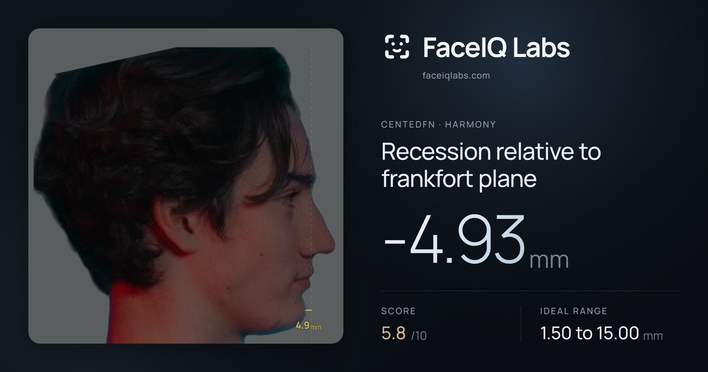CentedFN Recession relative to frankfort plane: -4.93mm, drawn on the photo