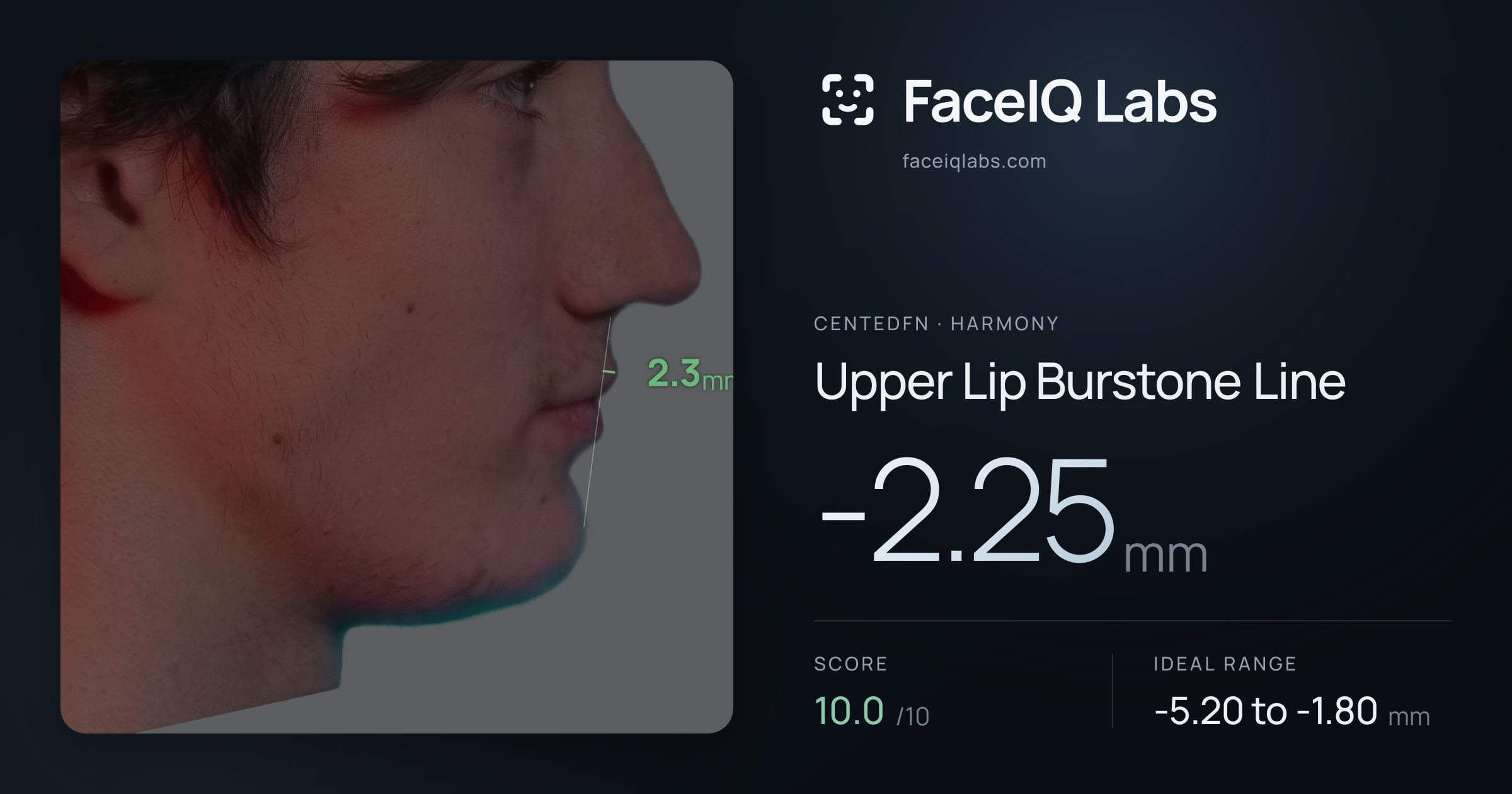 CentedFN Upper Lip Burstone Line: -2.25mm, drawn on the photo