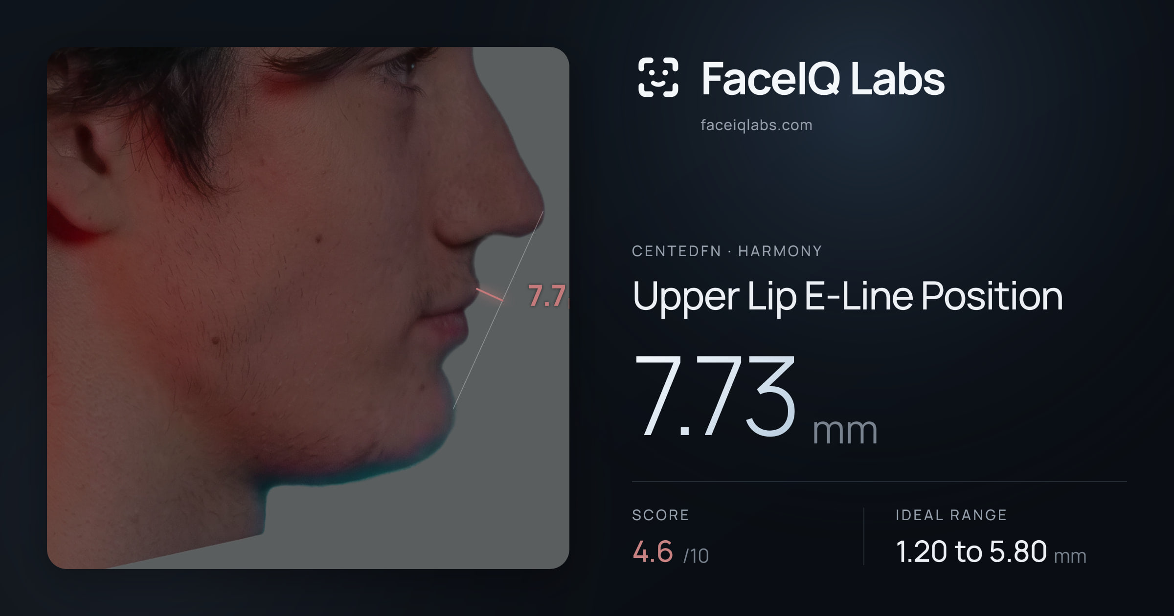 CentedFN Upper Lip E-Line Position: 7.73mm, drawn on the photo