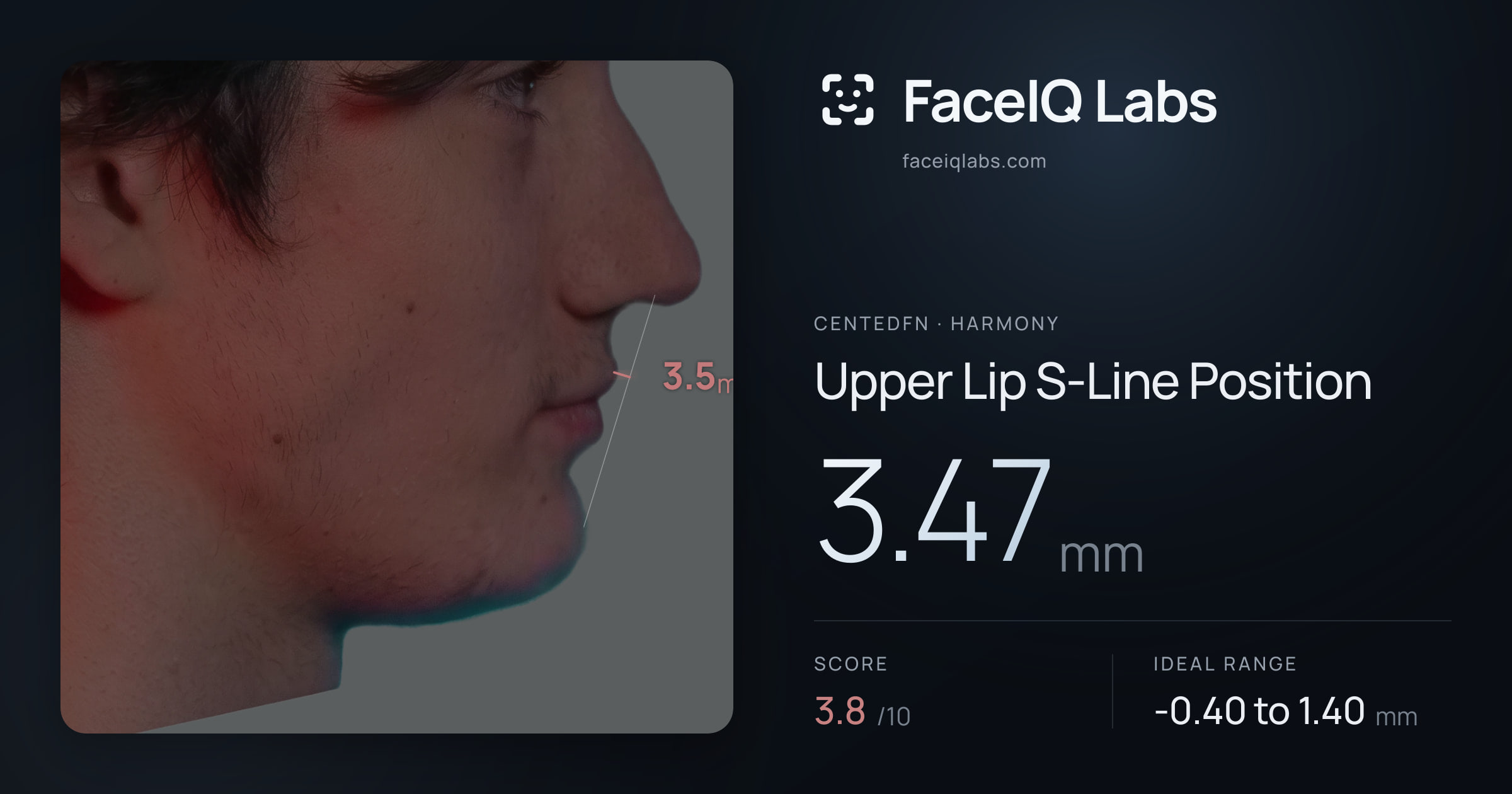 CentedFN Upper Lip S-Line Position: 3.47mm, drawn on the photo