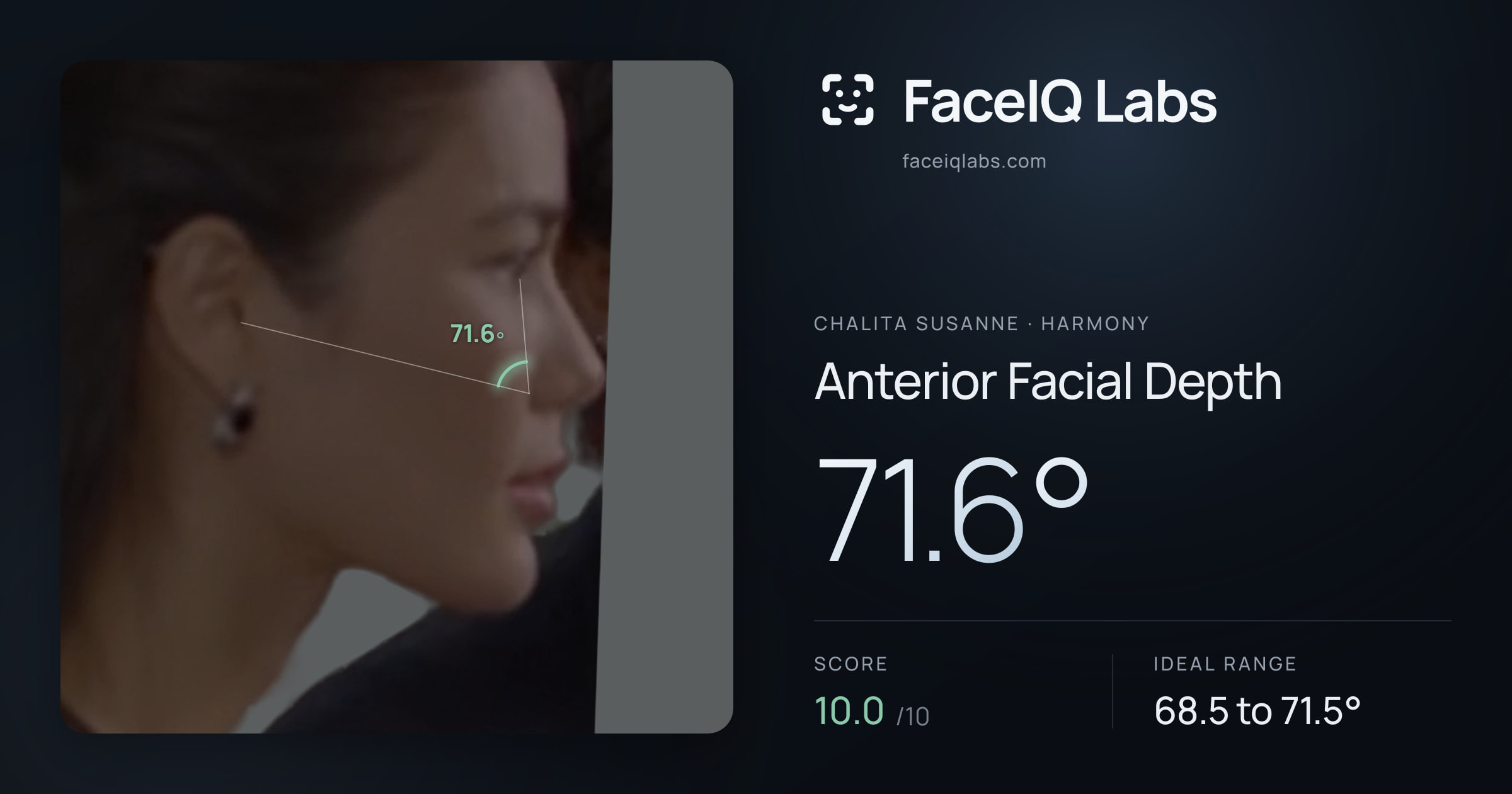 Chalita Susanne Anterior Facial Depth: 71.6°, drawn on the photo