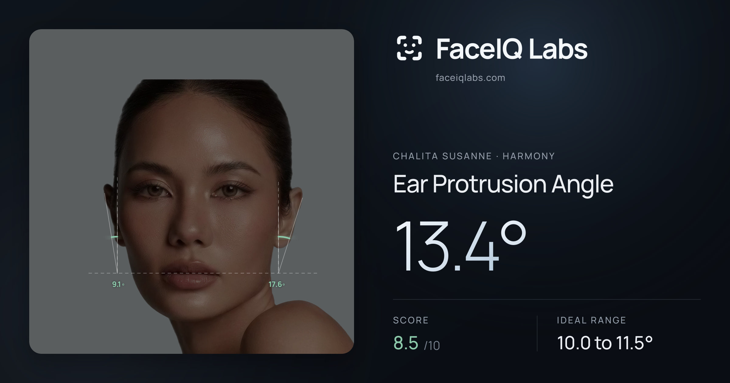 Chalita Susanne Ear Protrusion Angle: 13.4°, drawn on the photo