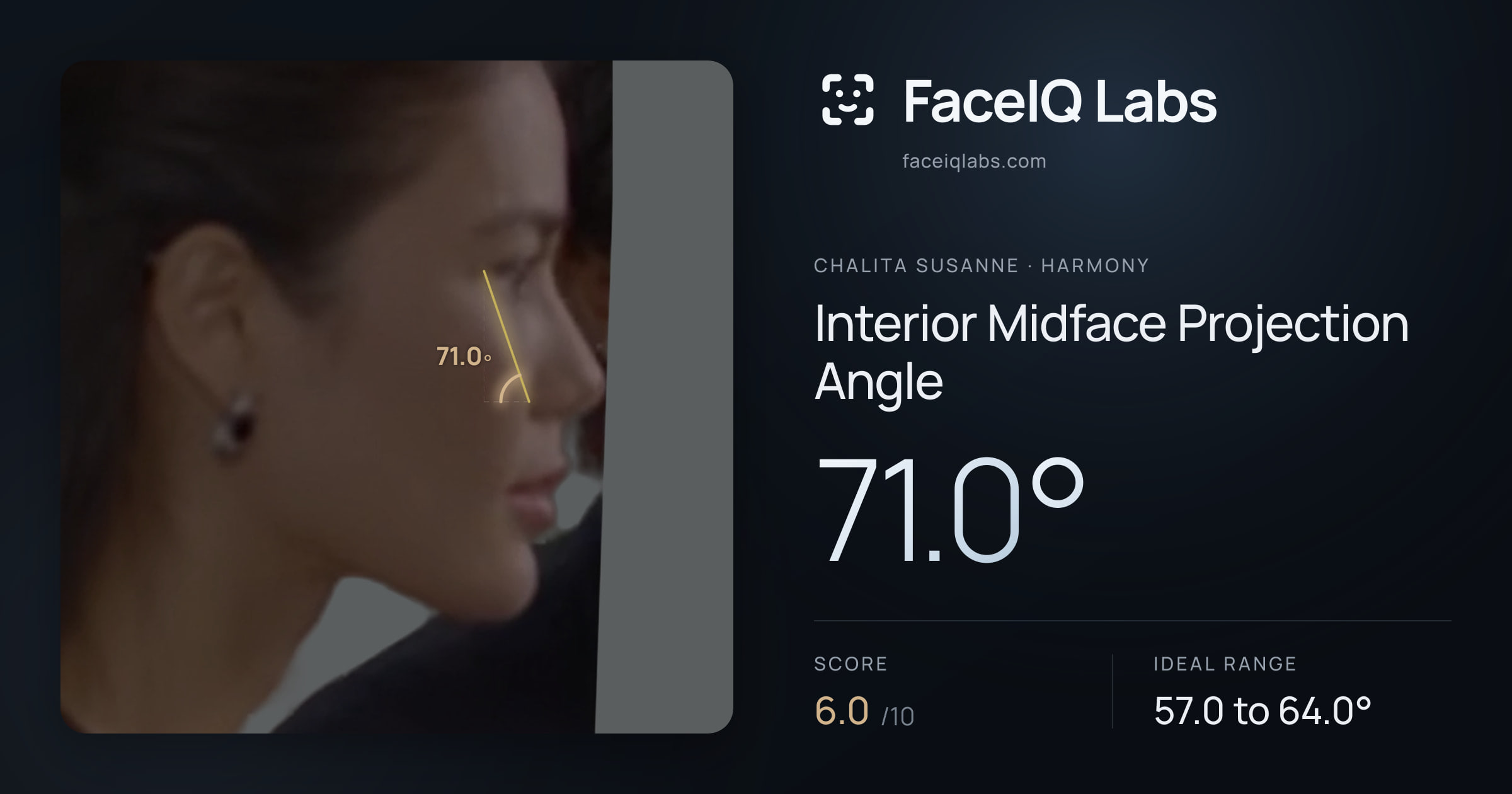 Chalita Susanne Interior Midface Projection Angle: 71.0°, drawn on the photo