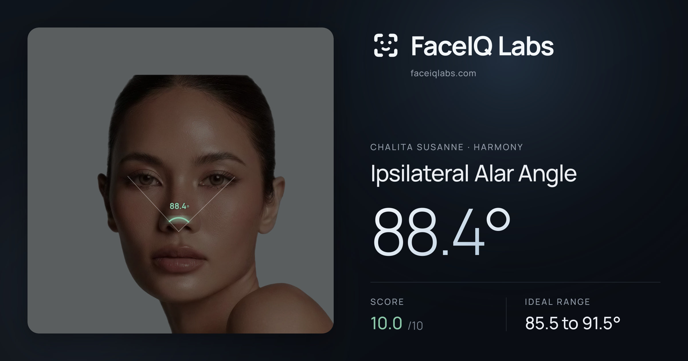 Chalita Susanne Ipsilateral Alar Angle: 88.4°, drawn on the photo