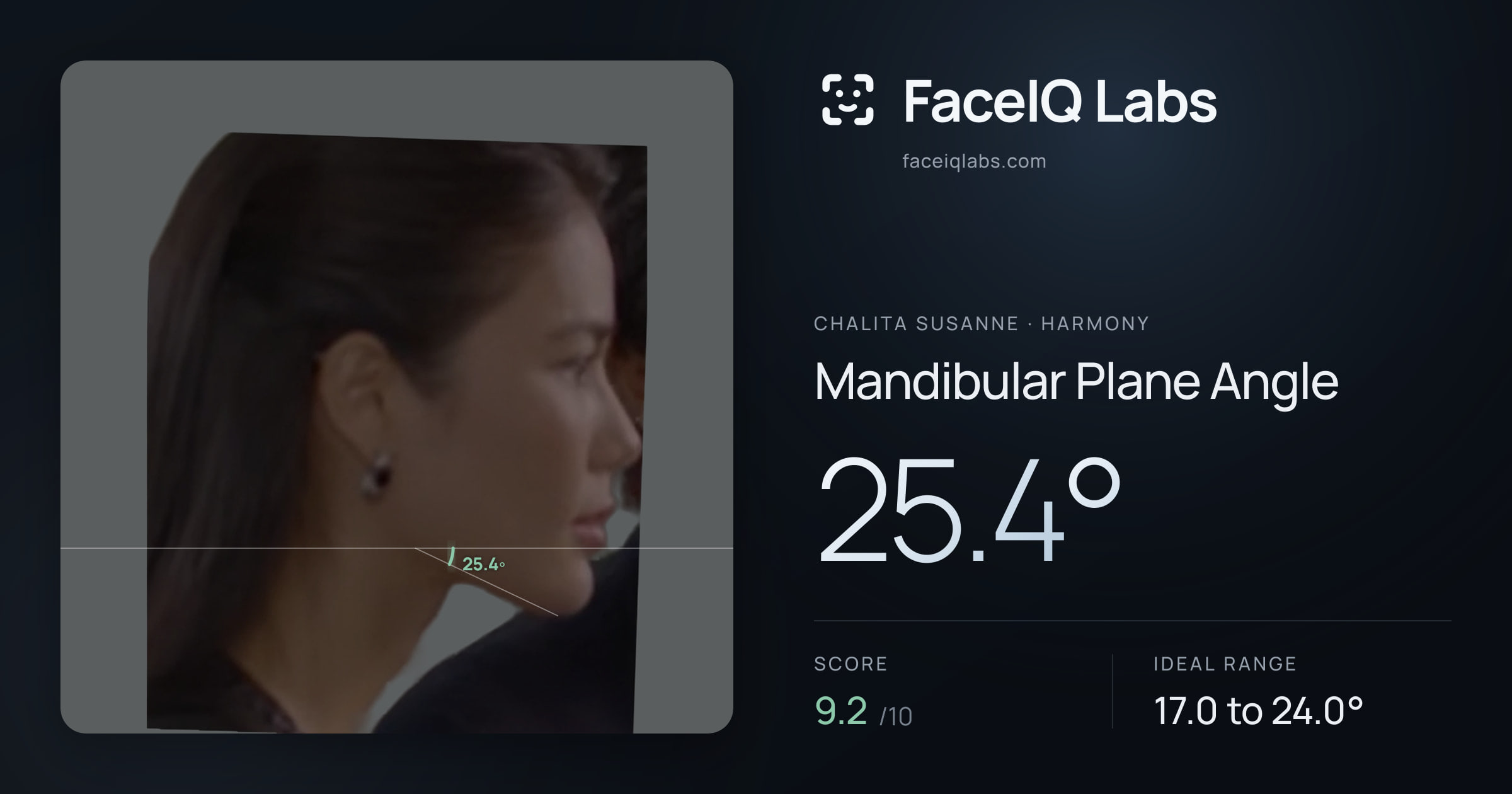 Chalita Susanne Mandibular Plane Angle: 25.4°, drawn on the photo