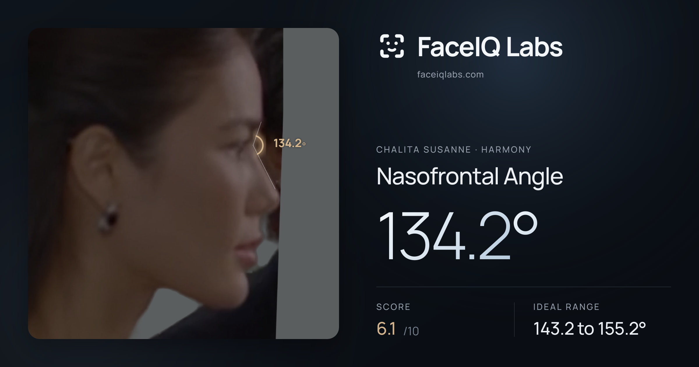 Chalita Susanne Nasofrontal Angle: 134.2°, drawn on the photo