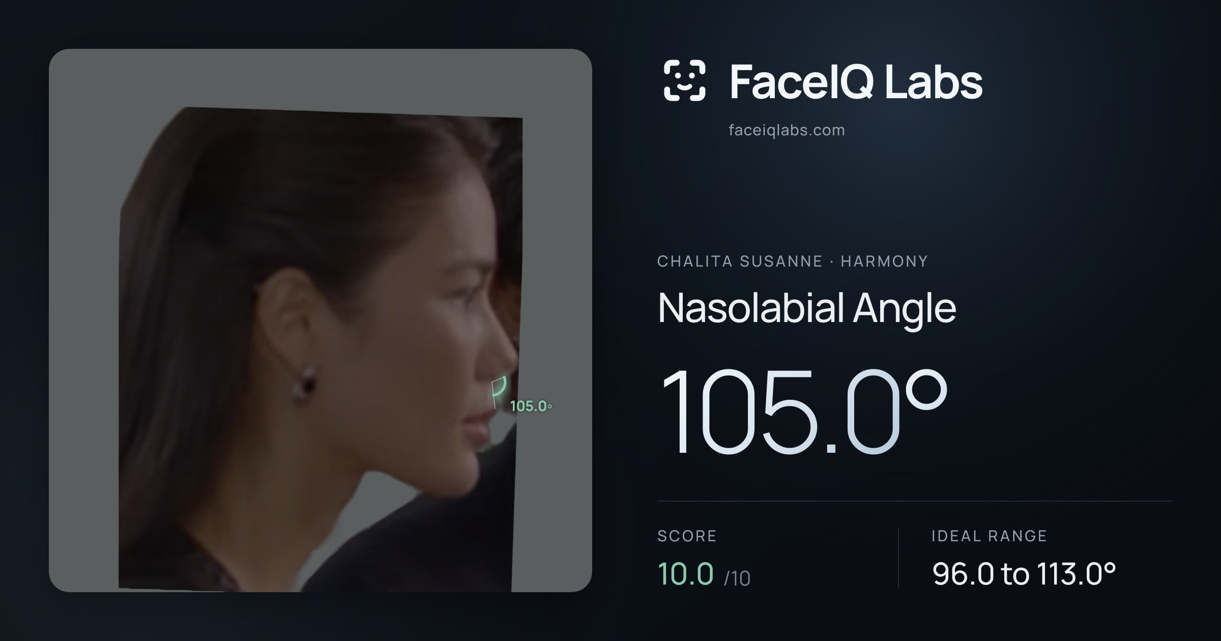 Chalita Susanne Nasolabial Angle: 105.0°, drawn on the photo
