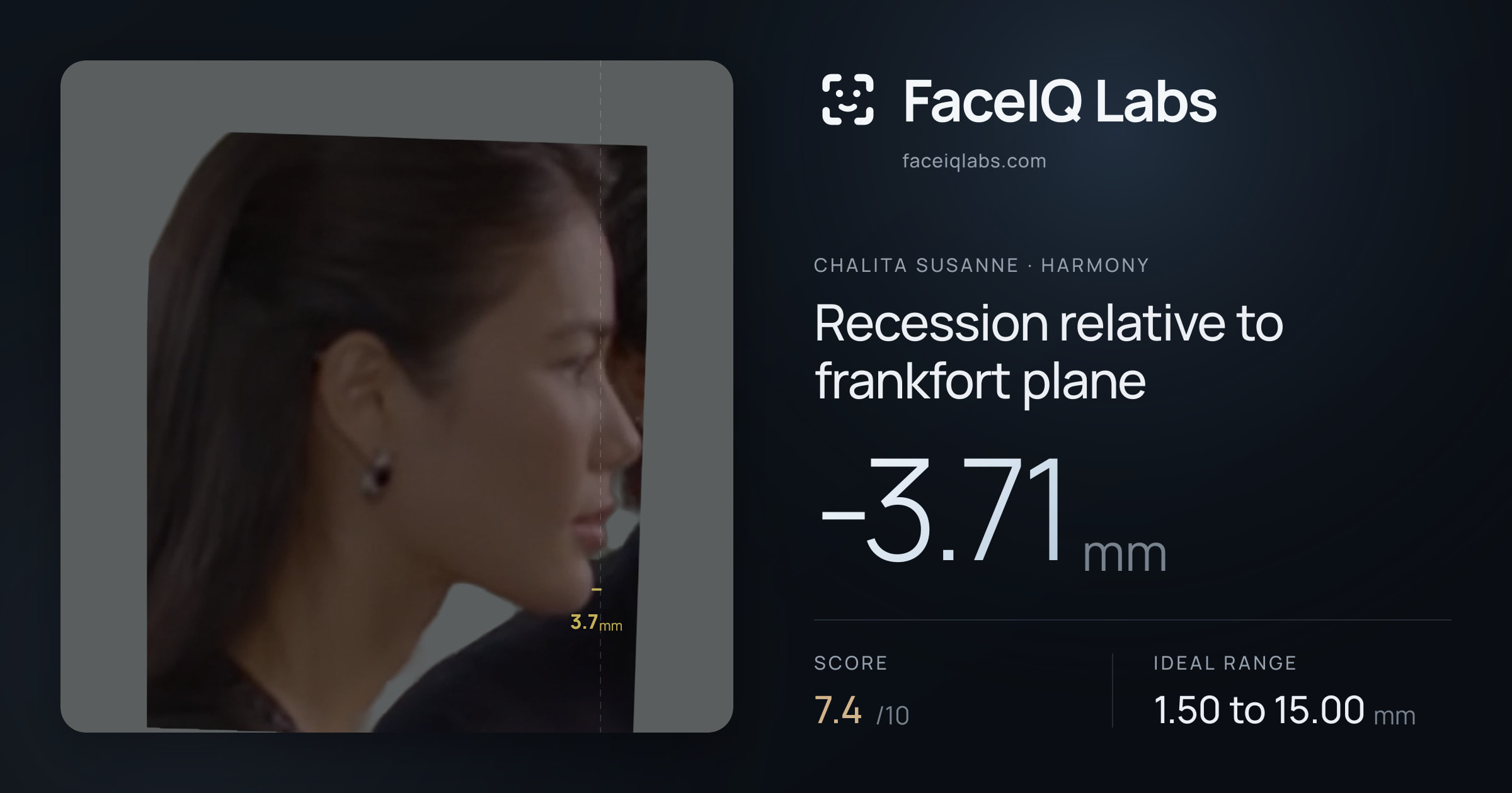 Chalita Susanne Recession relative to frankfort plane: -3.71mm, drawn on the photo
