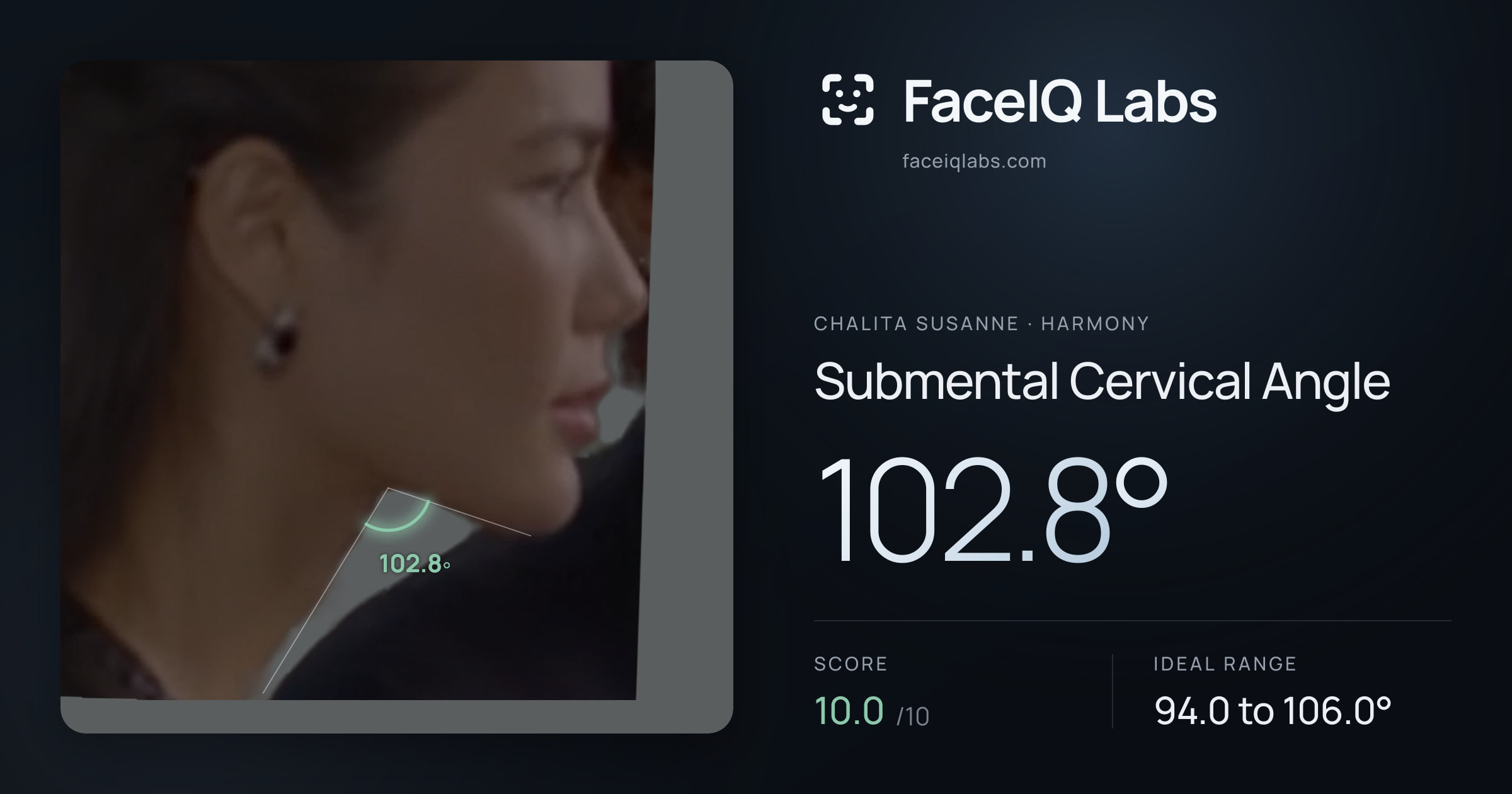 Chalita Susanne Submental Cervical Angle: 102.8°, drawn on the photo