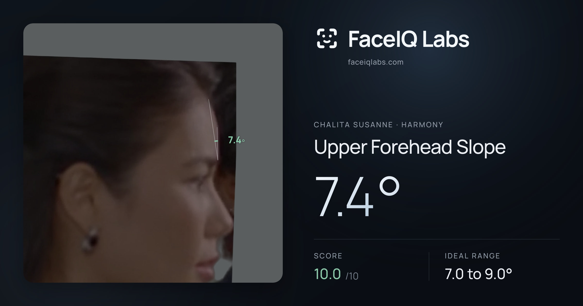 Chalita Susanne Upper Forehead Slope: 7.4°, drawn on the photo