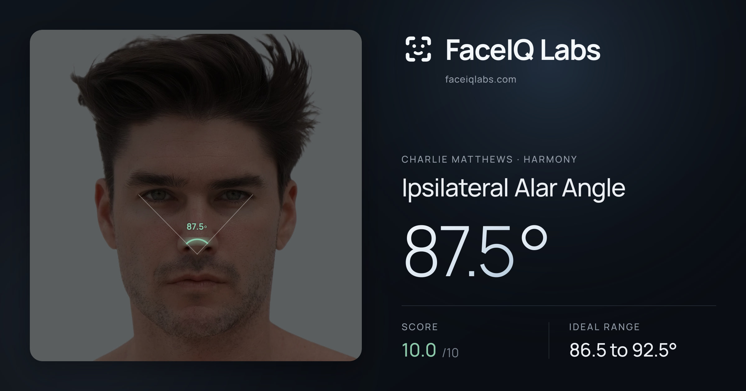 Charlie Matthews Ipsilateral Alar Angle: 87.5°, drawn on the photo