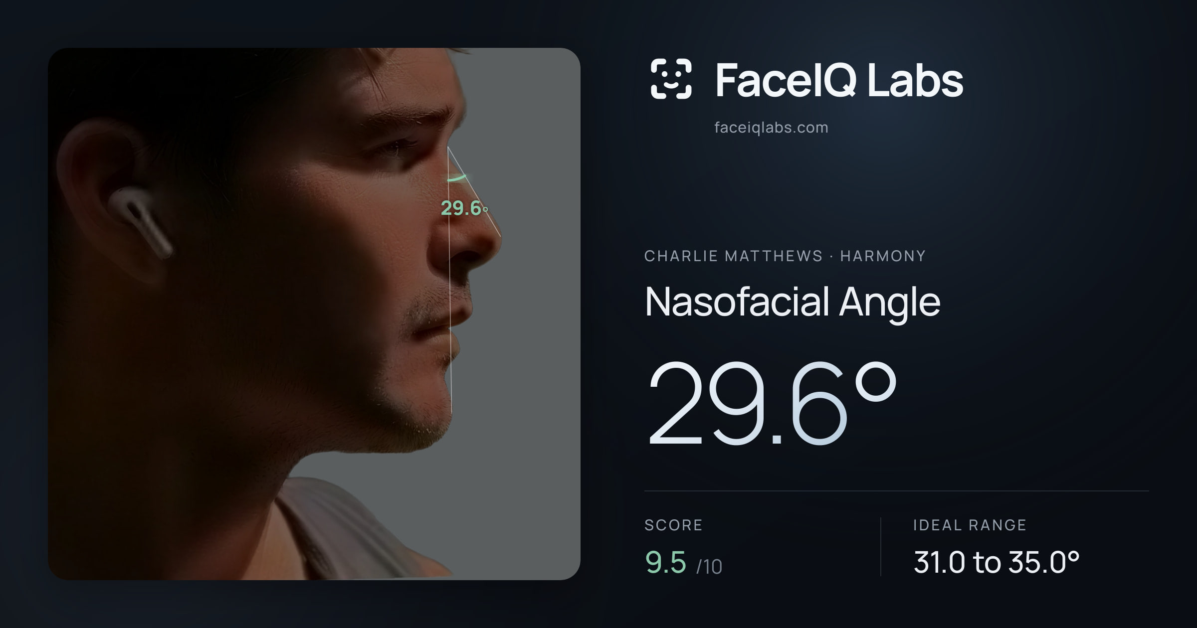 Charlie Matthews Nasofacial Angle: 29.6°, drawn on the photo