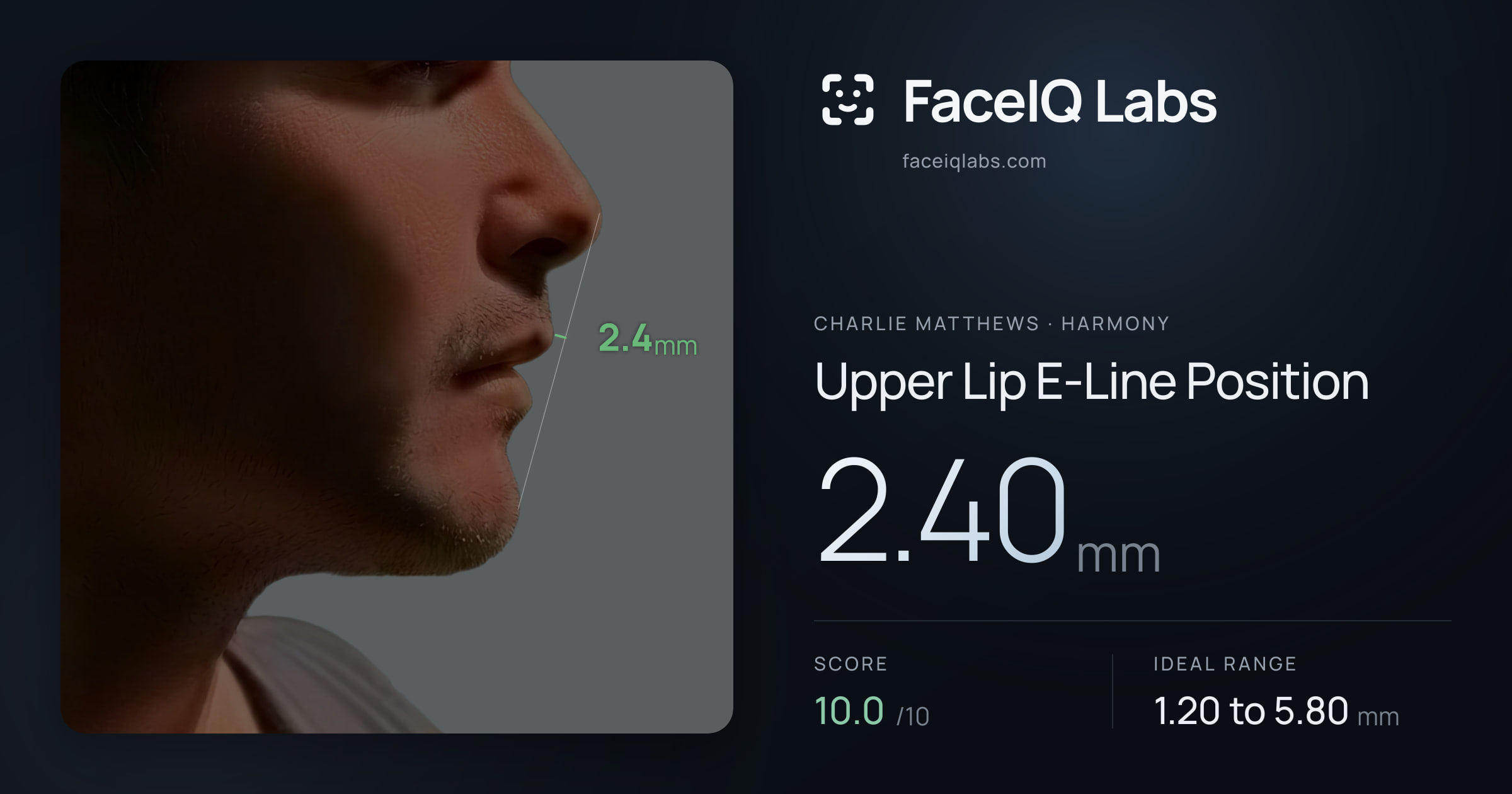 Charlie Matthews Upper Lip E-Line Position: 2.40mm, drawn on the photo
