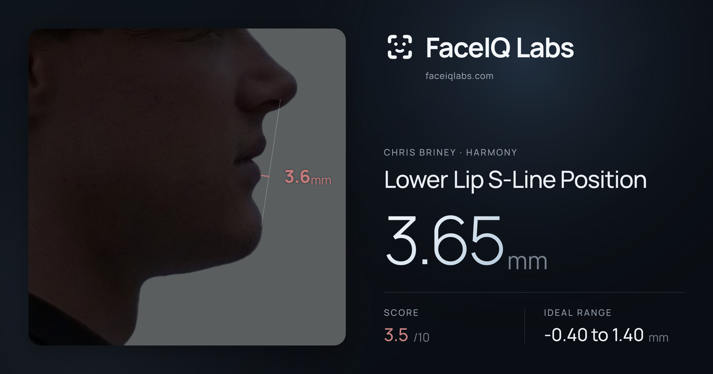 Chris Briney Lower Lip S-Line Position: 3.65mm, drawn on the photo