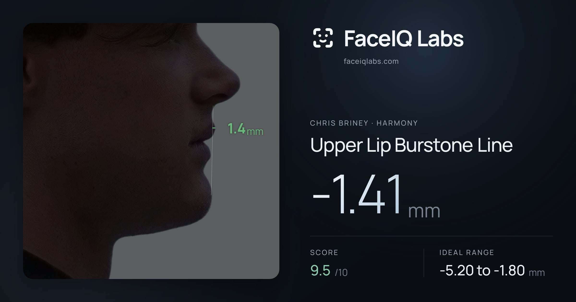 Chris Briney Upper Lip Burstone Line: -1.41mm, drawn on the photo