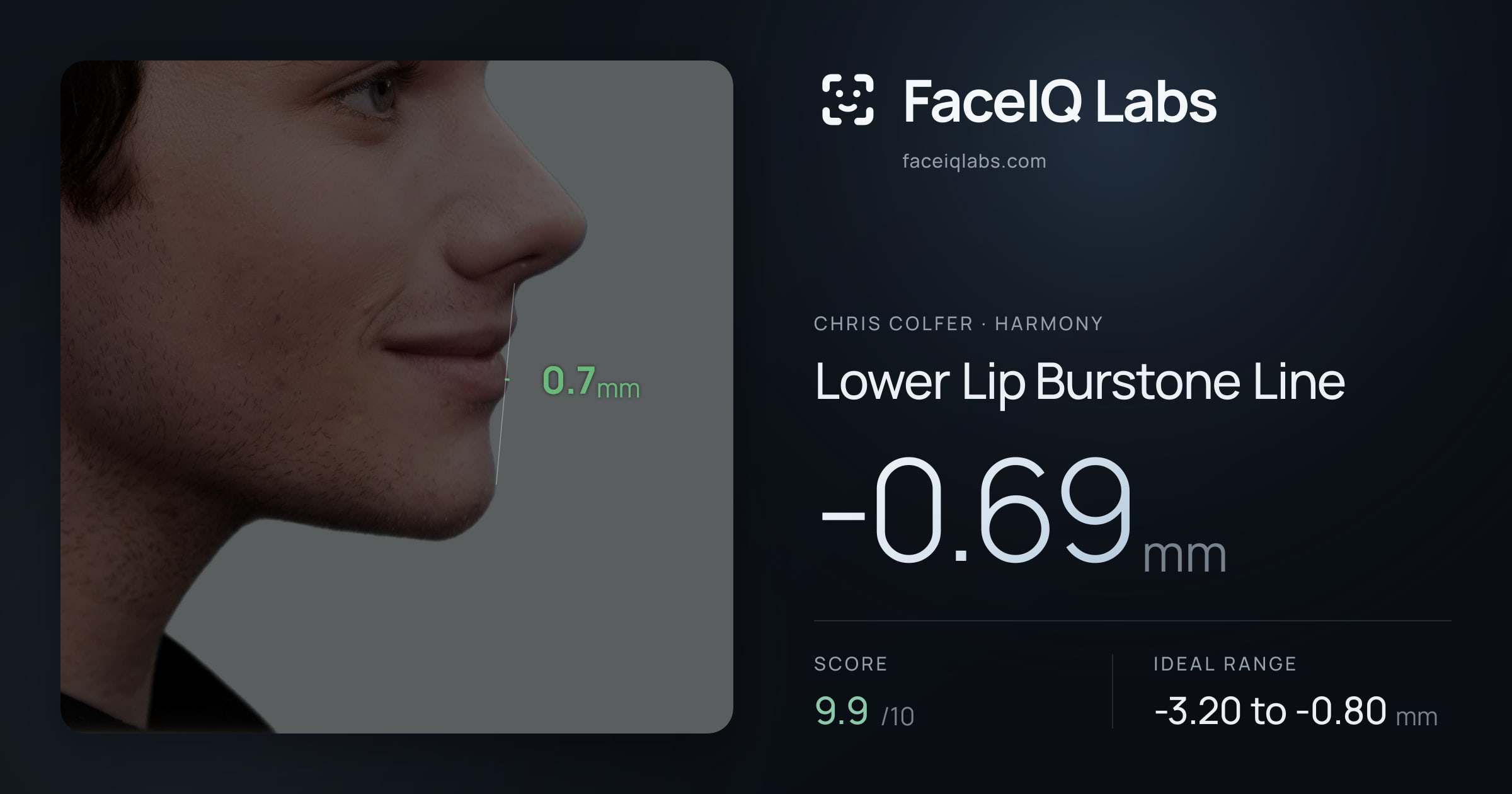 Chris Colfer Lower Lip Burstone Line: -0.69mm, drawn on the photo