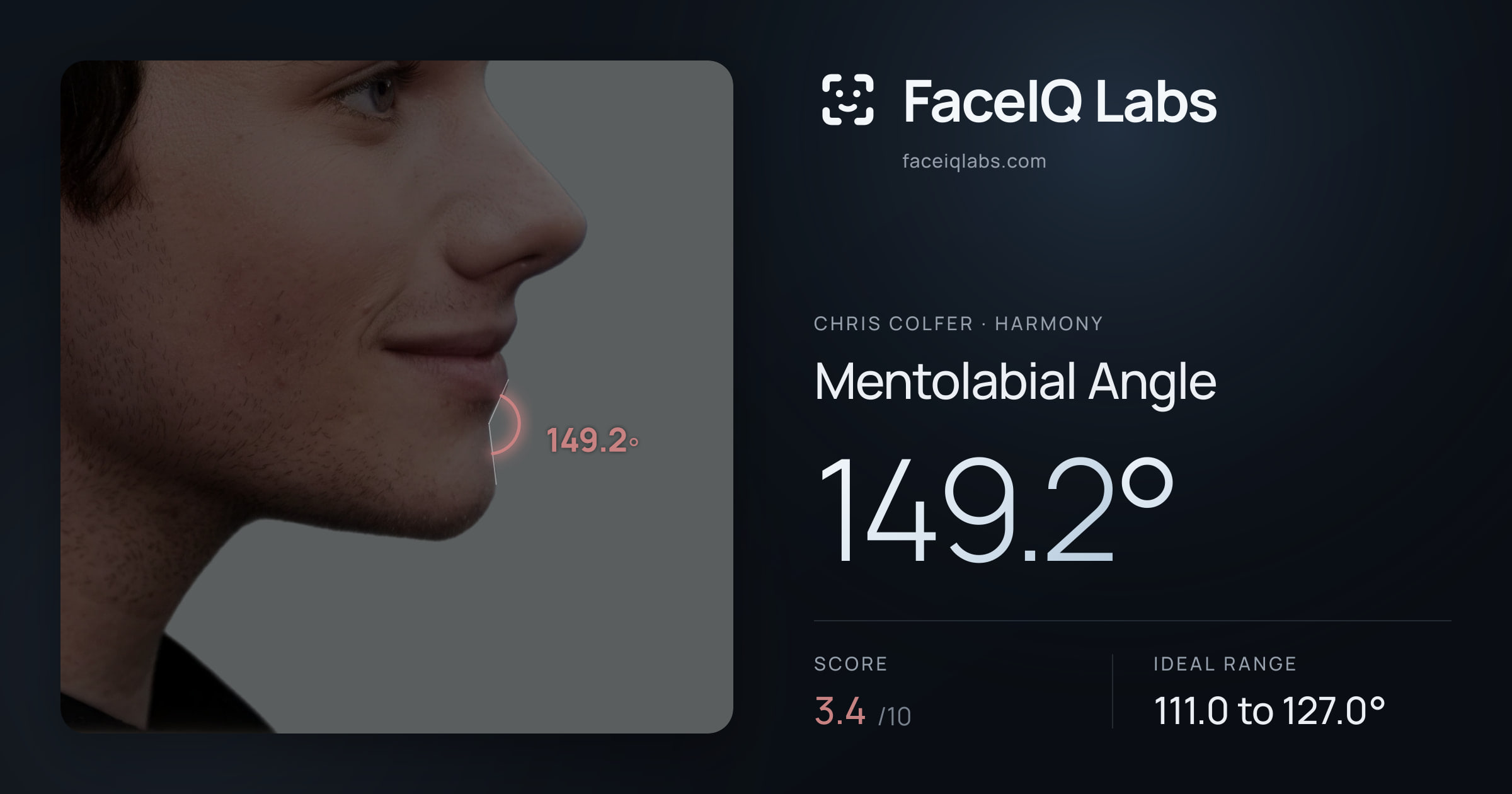 Chris Colfer Mentolabial Angle: 149.2°, drawn on the photo