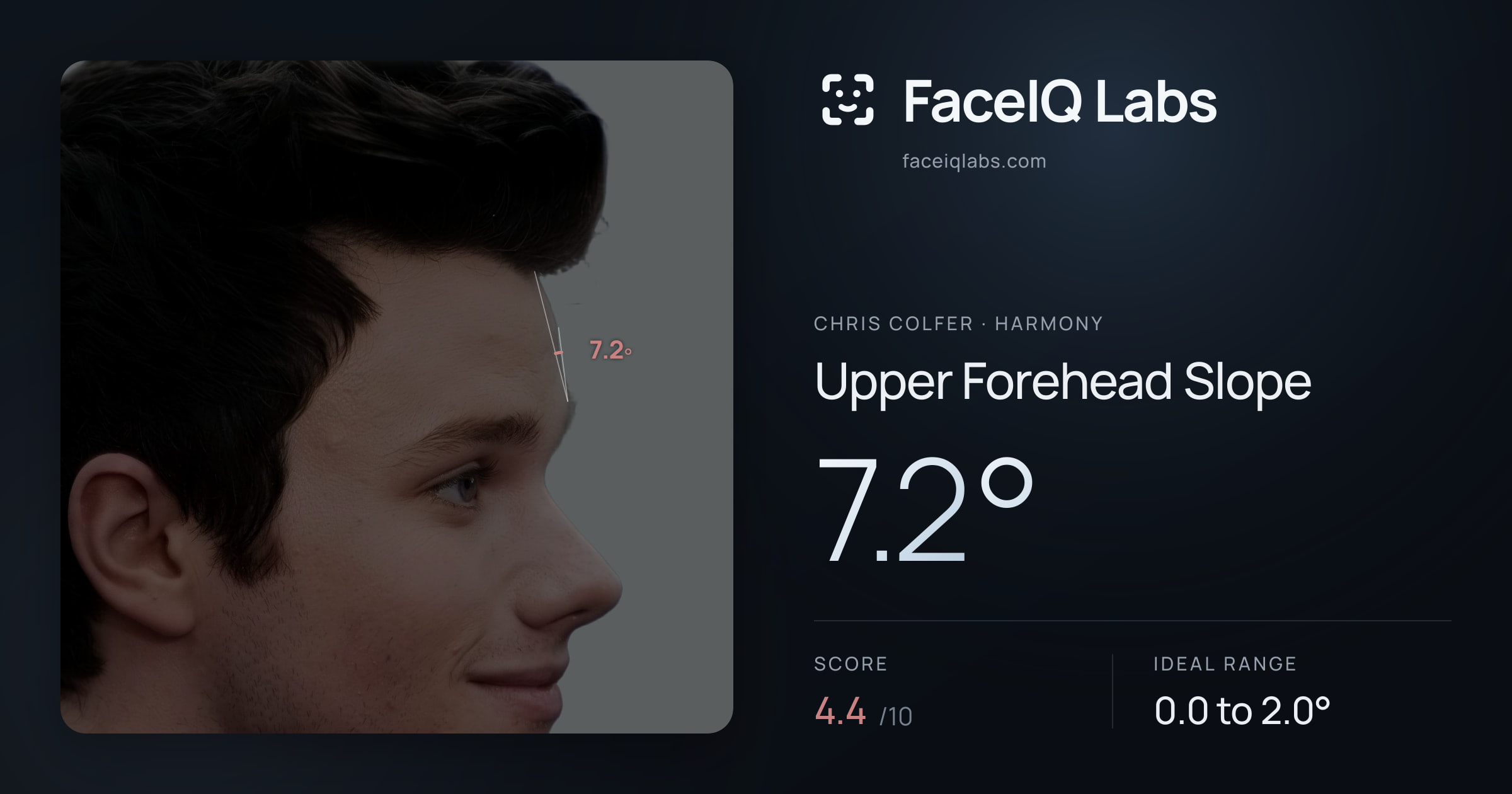 Chris Colfer Upper Forehead Slope: 7.2°, drawn on the photo