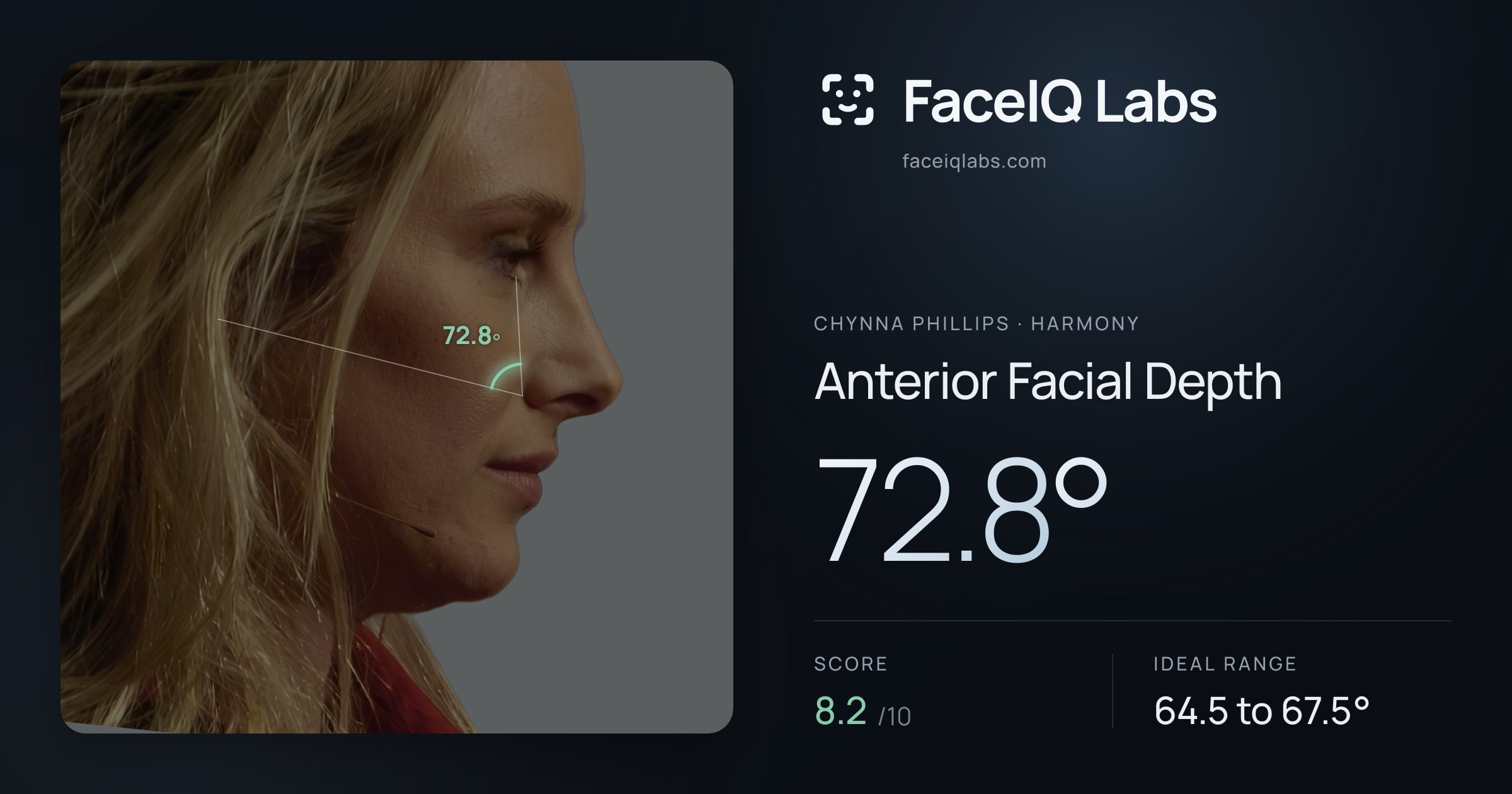 Chynna Phillips Anterior Facial Depth: 72.8°, drawn on the photo