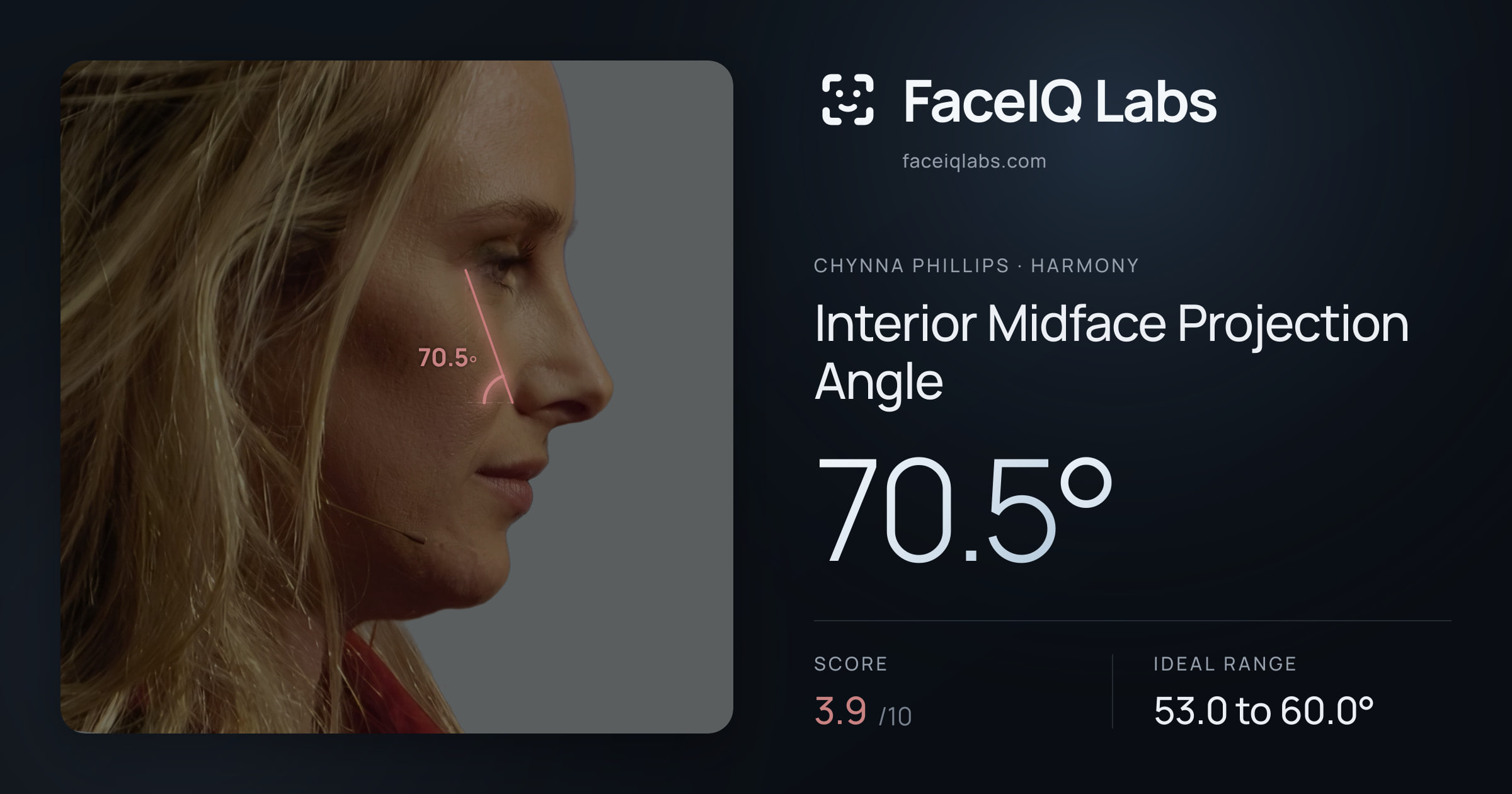 Chynna Phillips Interior Midface Projection Angle: 70.5°, drawn on the photo