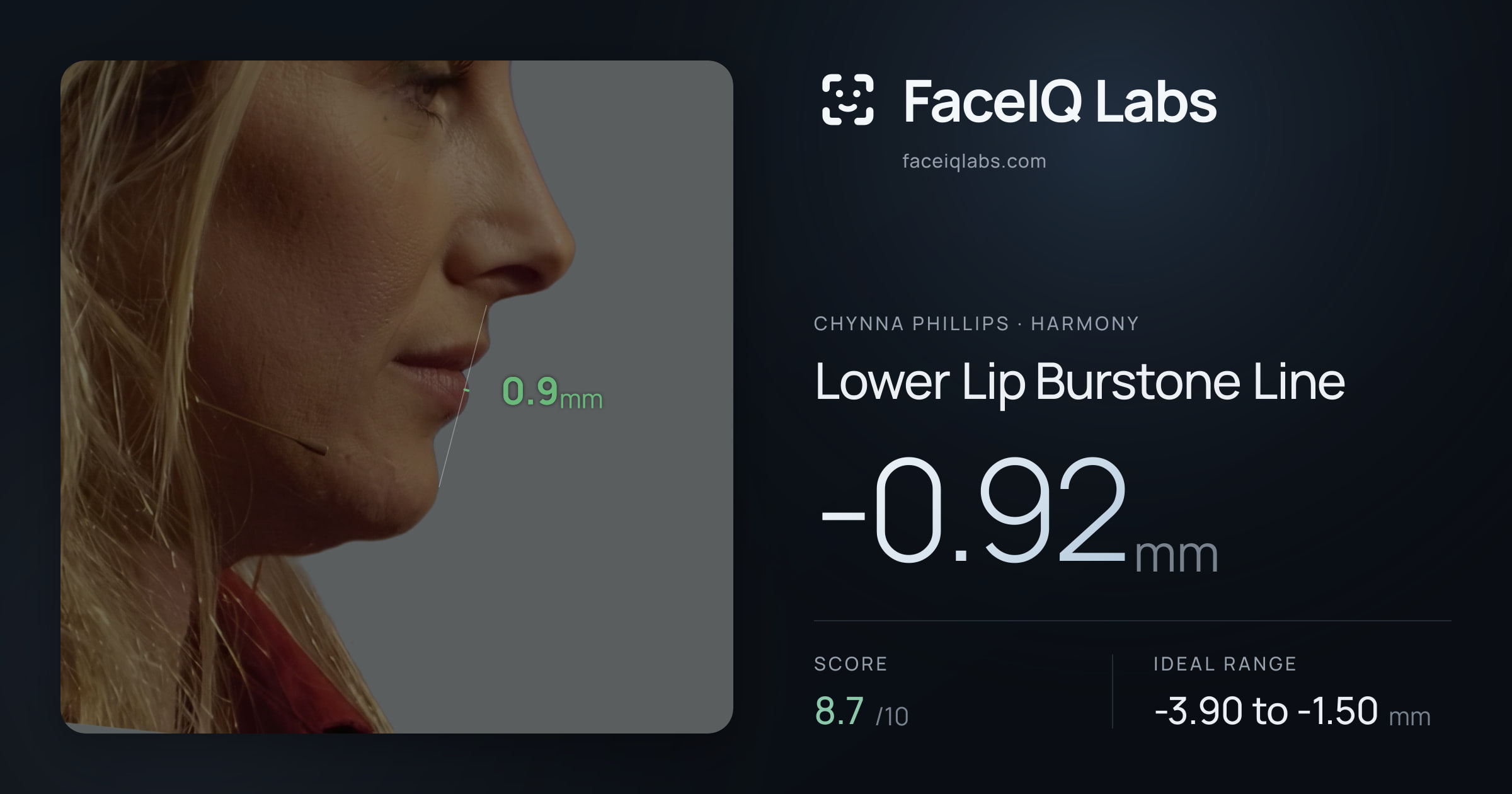 Chynna Phillips Lower Lip Burstone Line: -0.92mm, drawn on the photo
