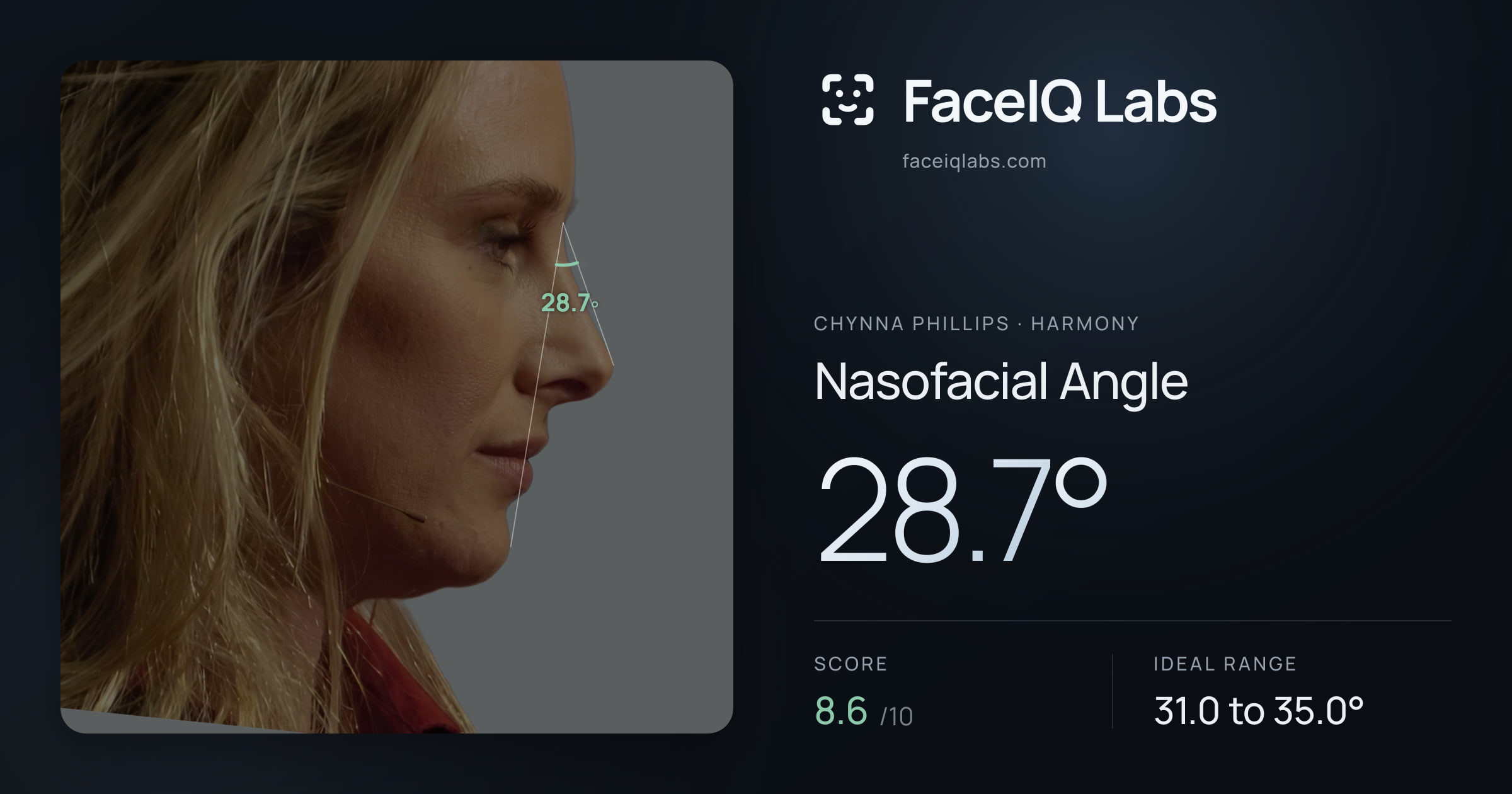 Chynna Phillips Nasofacial Angle: 28.7°, drawn on the photo