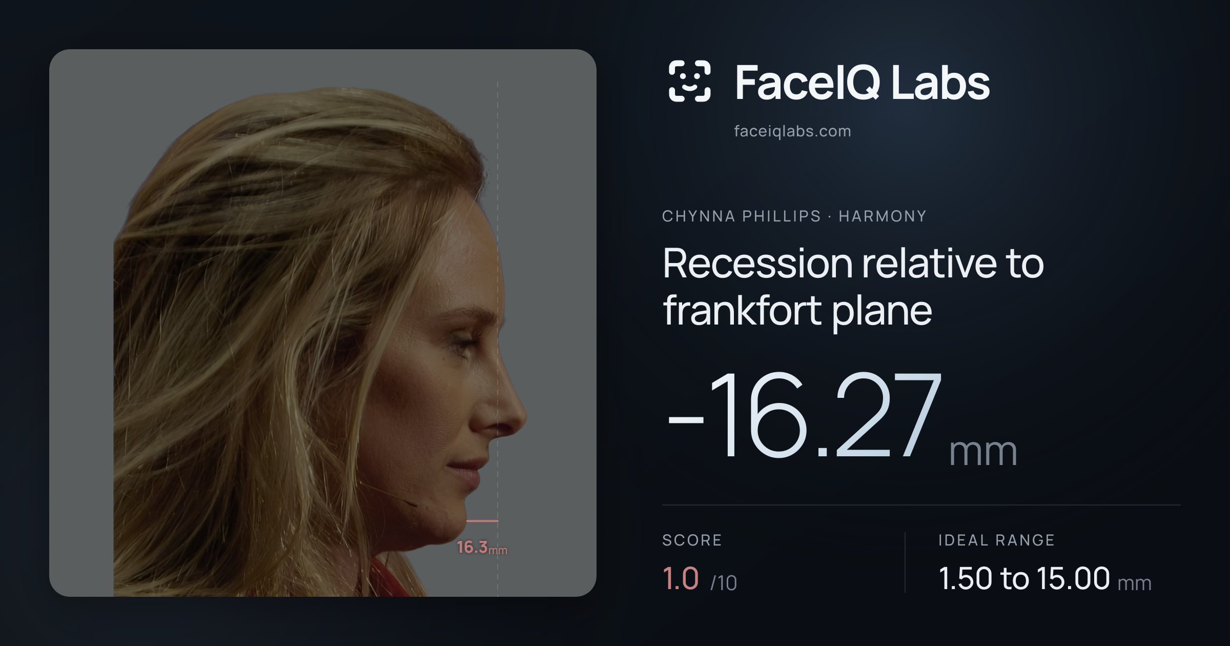 Chynna Phillips Recession relative to frankfort plane: -16.27mm, drawn on the photo
