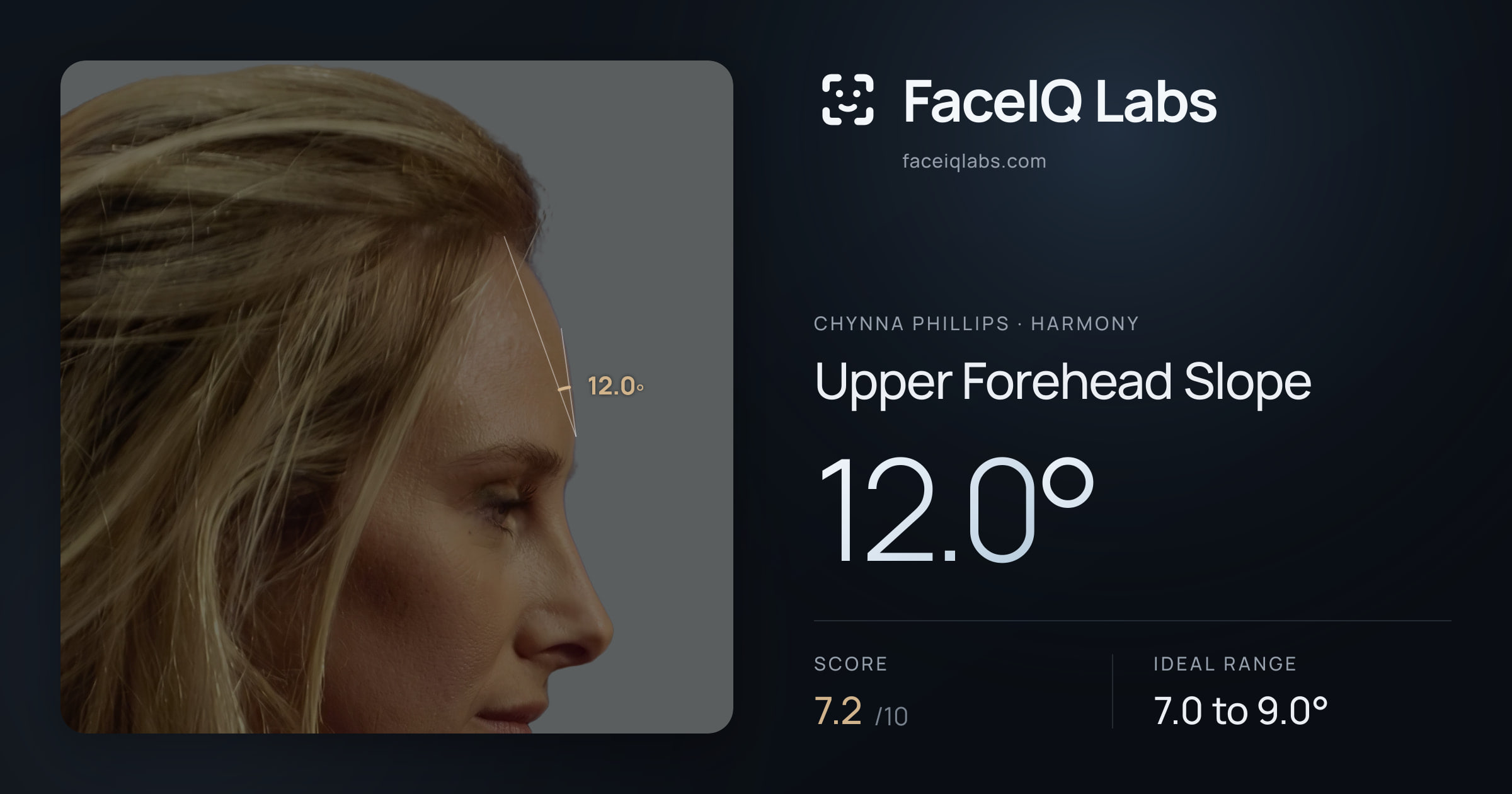 Chynna Phillips Upper Forehead Slope: 12.0°, drawn on the photo
