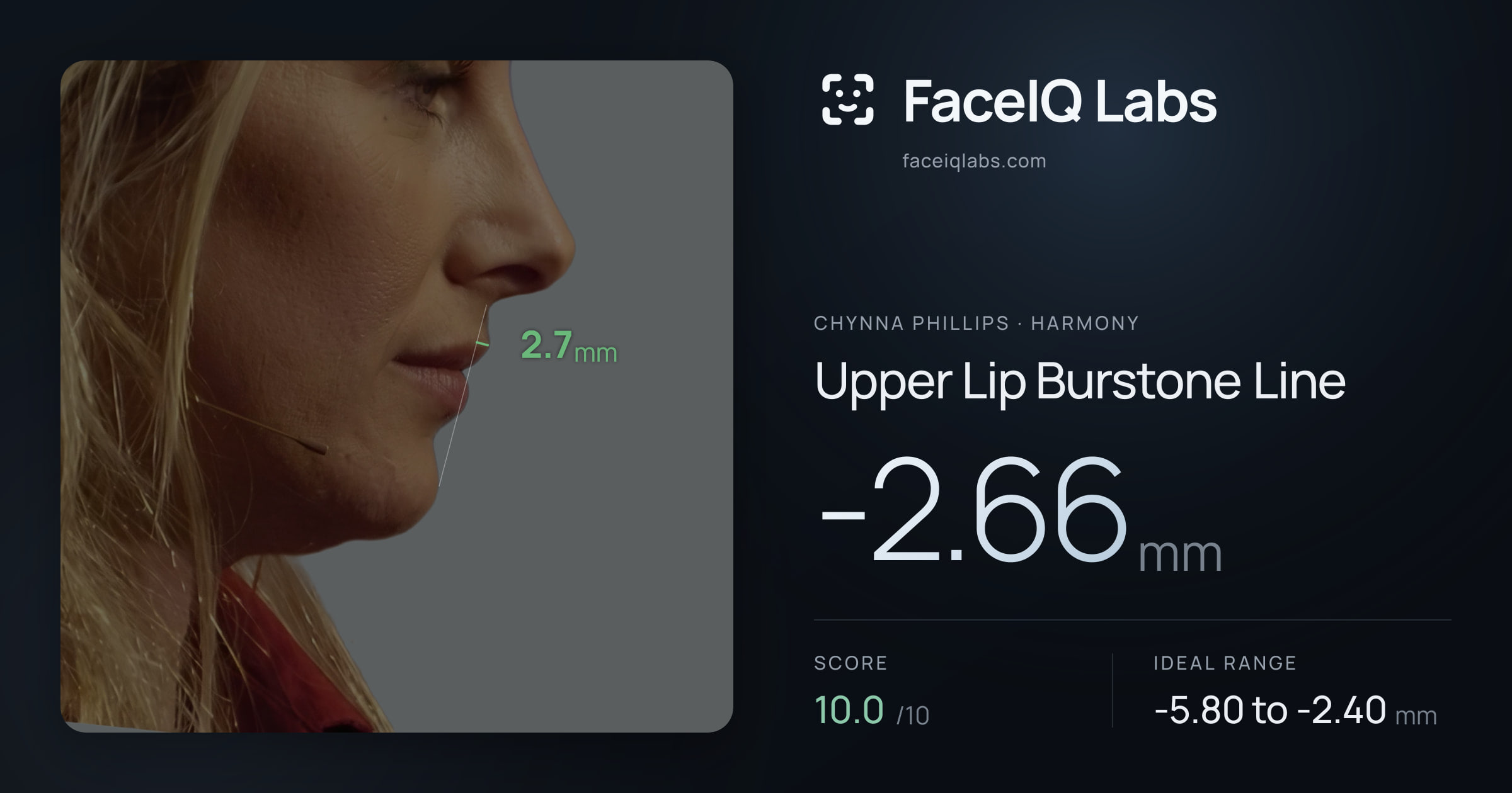 Chynna Phillips Upper Lip Burstone Line: -2.66mm, drawn on the photo