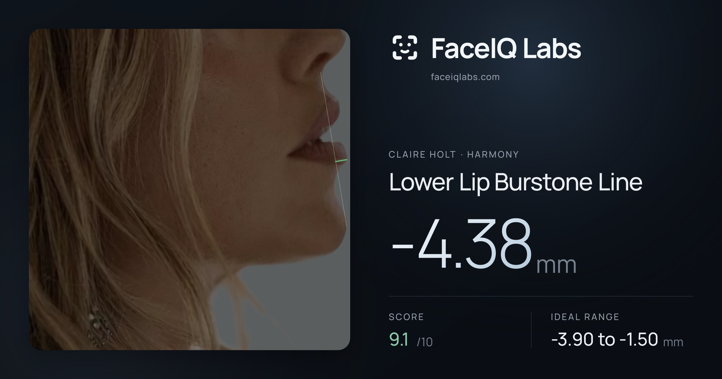 Claire Holt Lower Lip Burstone Line: -4.38mm, drawn on the photo