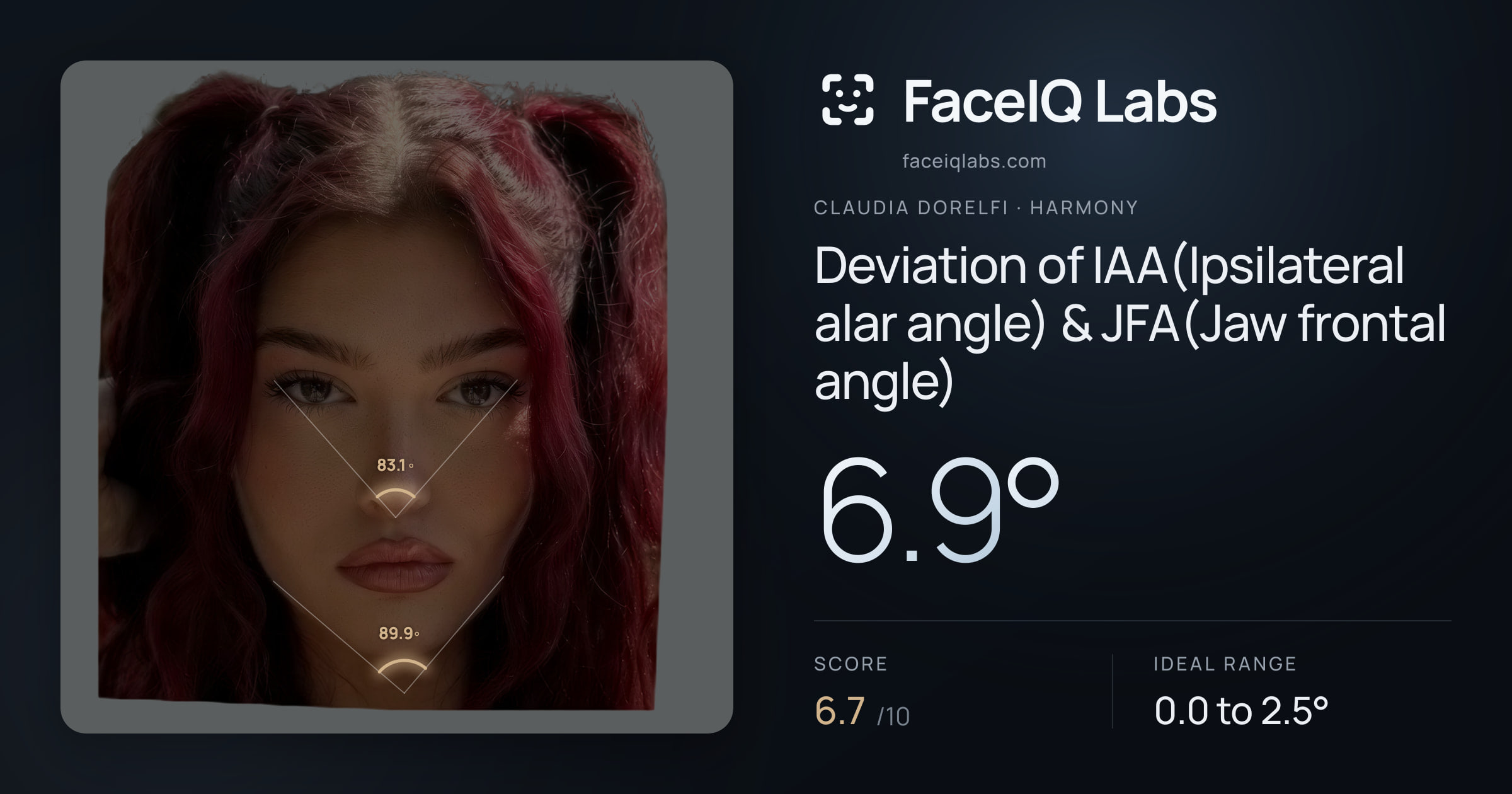 Claudia Dorelfi Deviation of IAA(Ipsilateral alar angle) & JFA(Jaw frontal angle): 6.9°, drawn on the photo