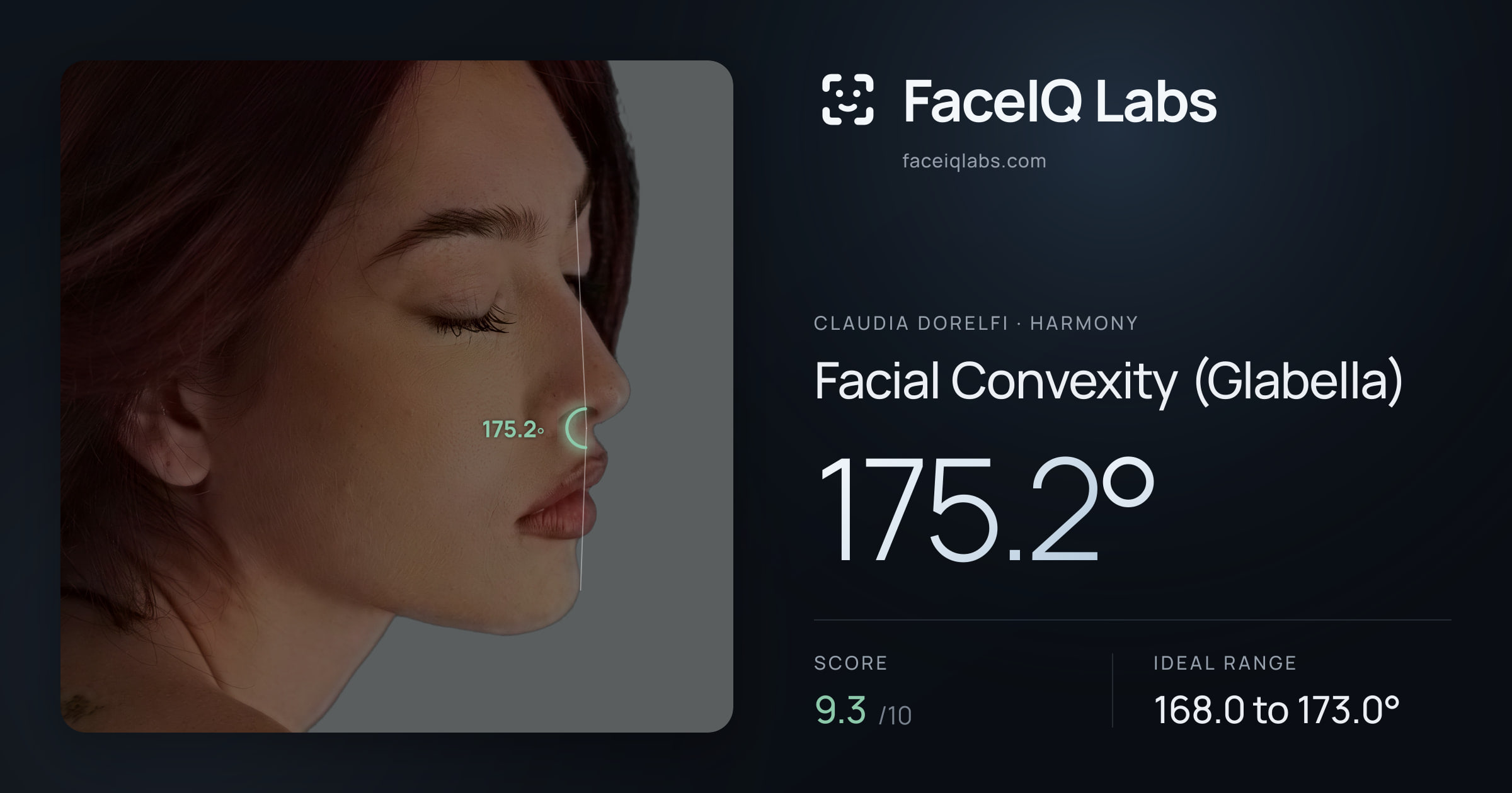 Claudia Dorelfi Facial Convexity (Glabella): 175.2°, drawn on the photo