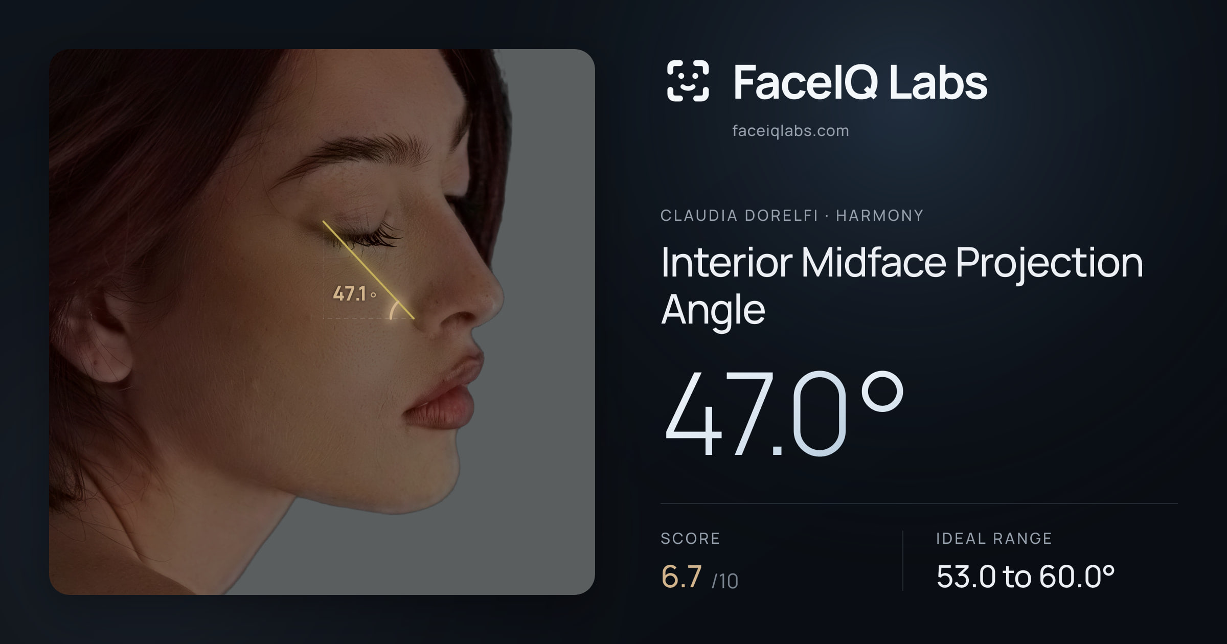 Claudia Dorelfi Interior Midface Projection Angle: 47.0°, drawn on the photo