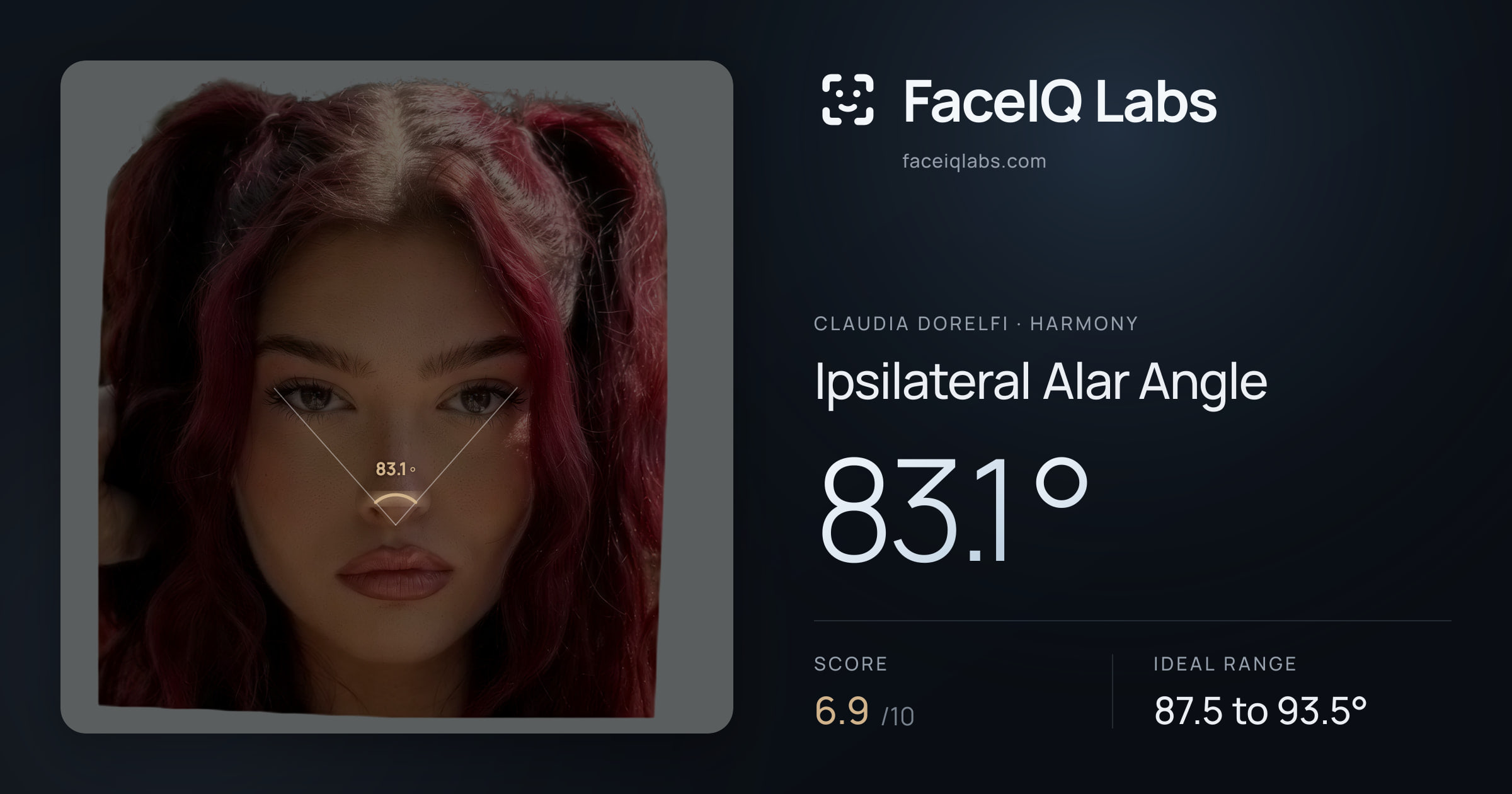 Claudia Dorelfi Ipsilateral Alar Angle: 83.1°, drawn on the photo