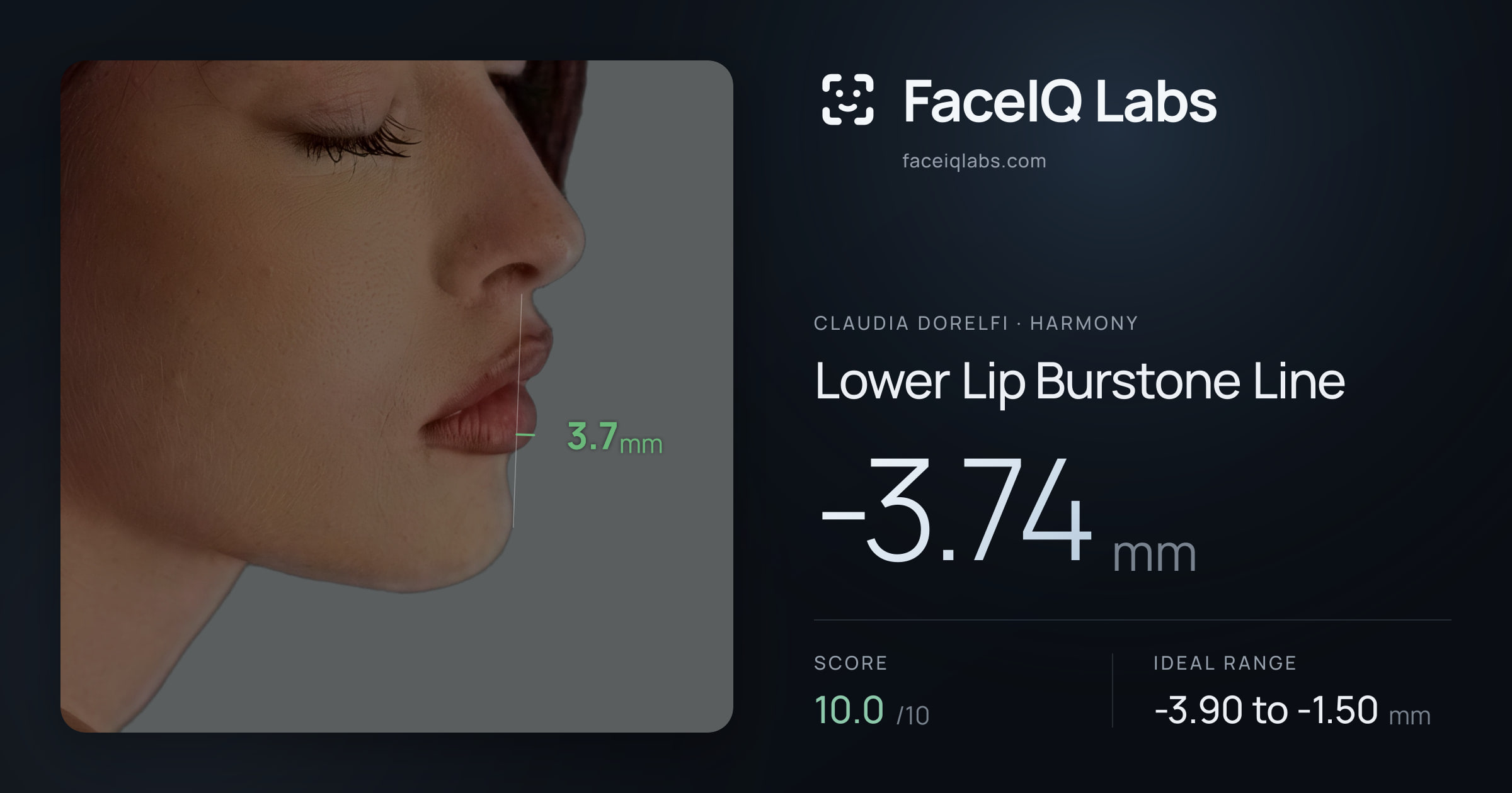 Claudia Dorelfi Lower Lip Burstone Line: -3.74mm, drawn on the photo