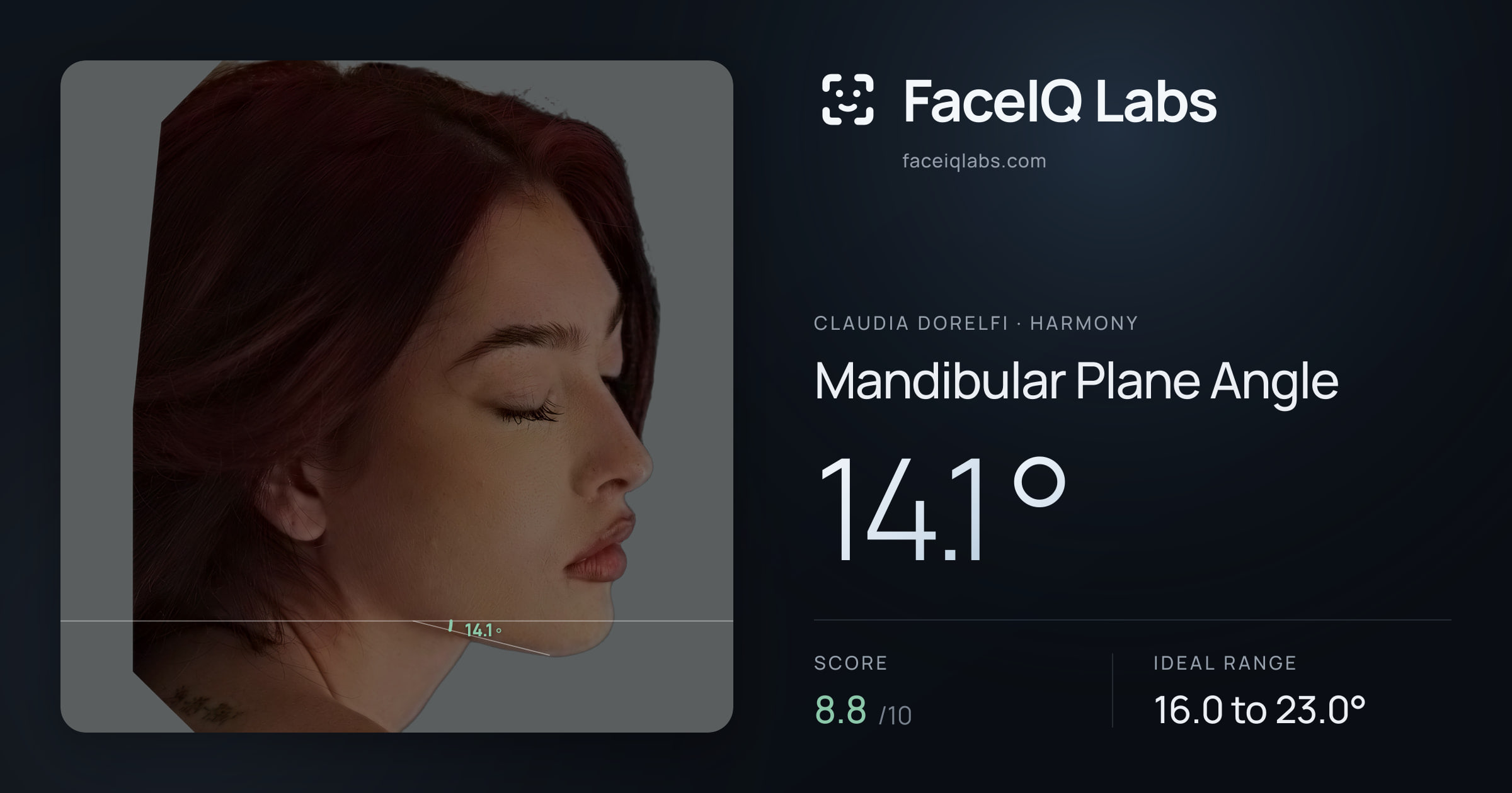 Claudia Dorelfi Mandibular Plane Angle: 14.1°, drawn on the photo