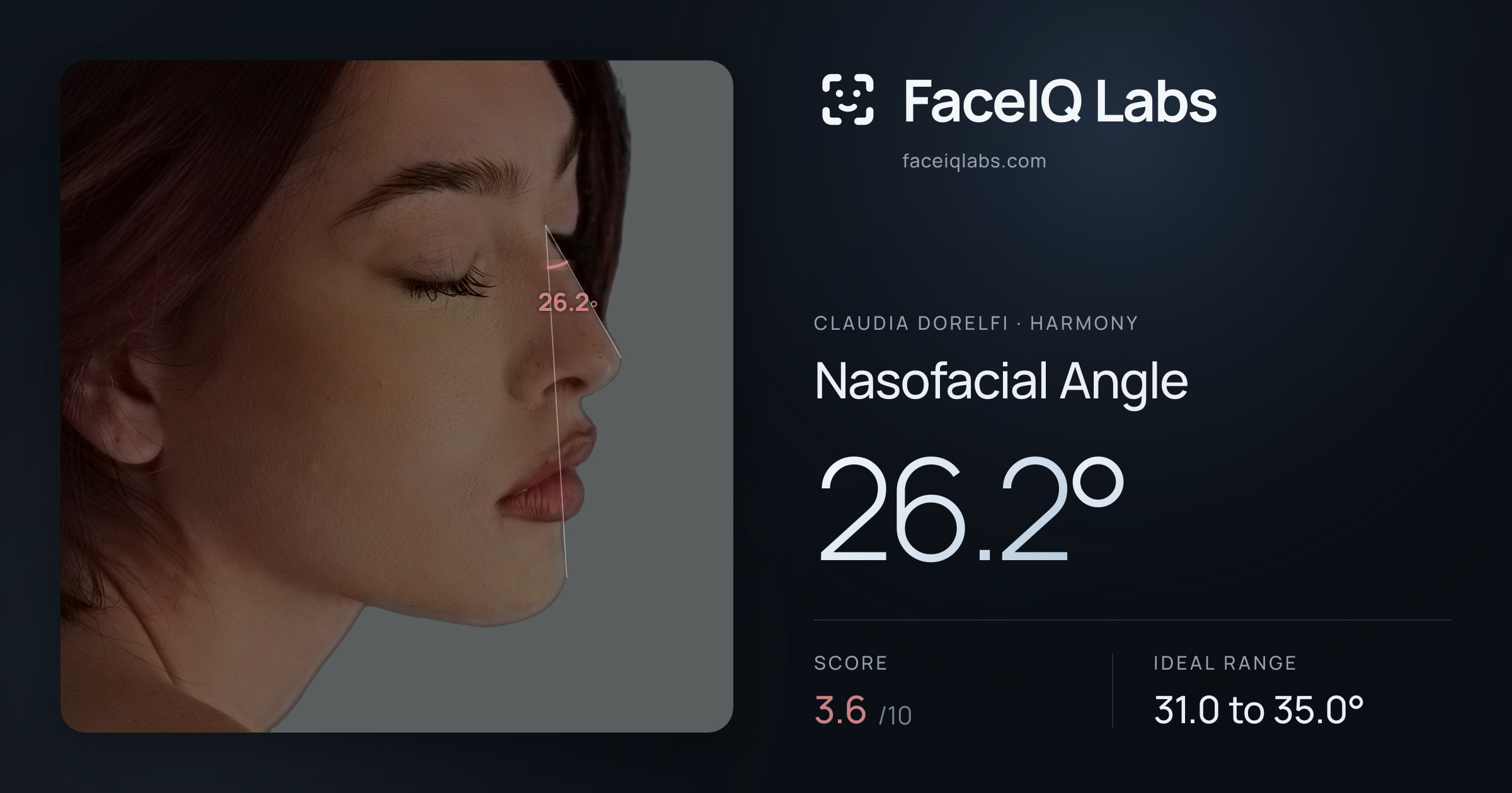 Claudia Dorelfi Nasofacial Angle: 26.2°, drawn on the photo