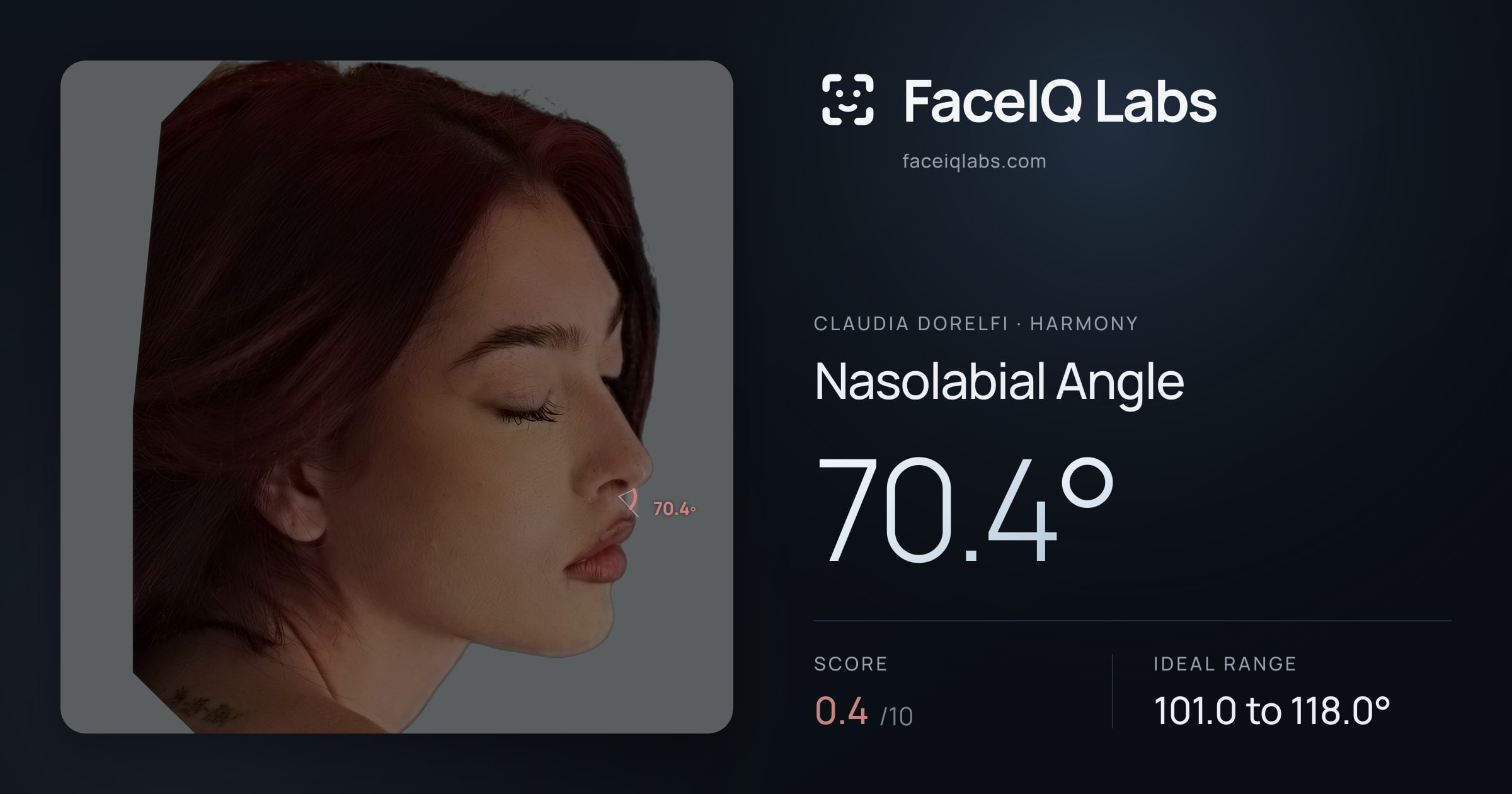 Claudia Dorelfi Nasolabial Angle: 70.4°, drawn on the photo