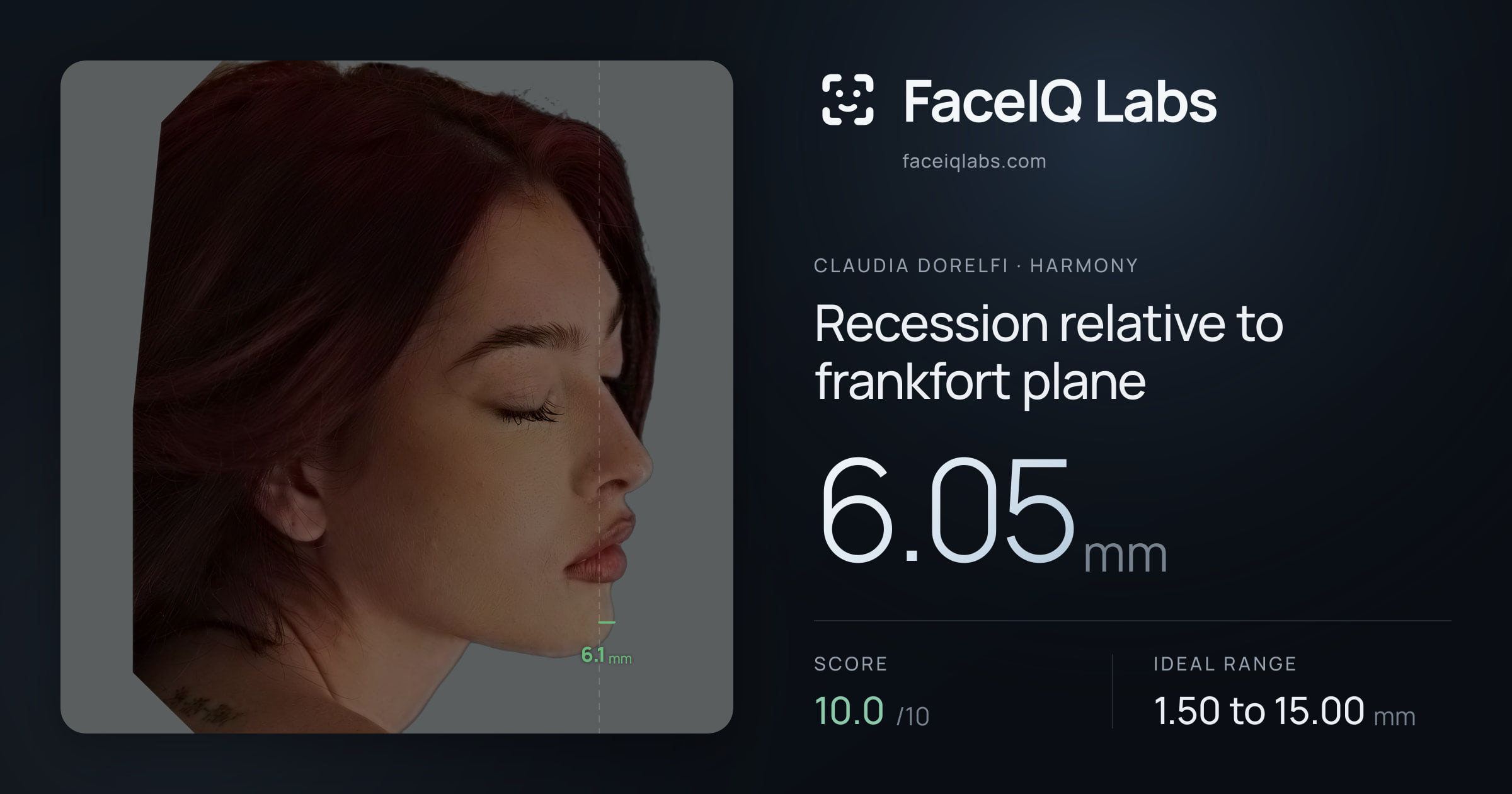 Claudia Dorelfi Recession relative to frankfort plane: 6.05mm, drawn on the photo
