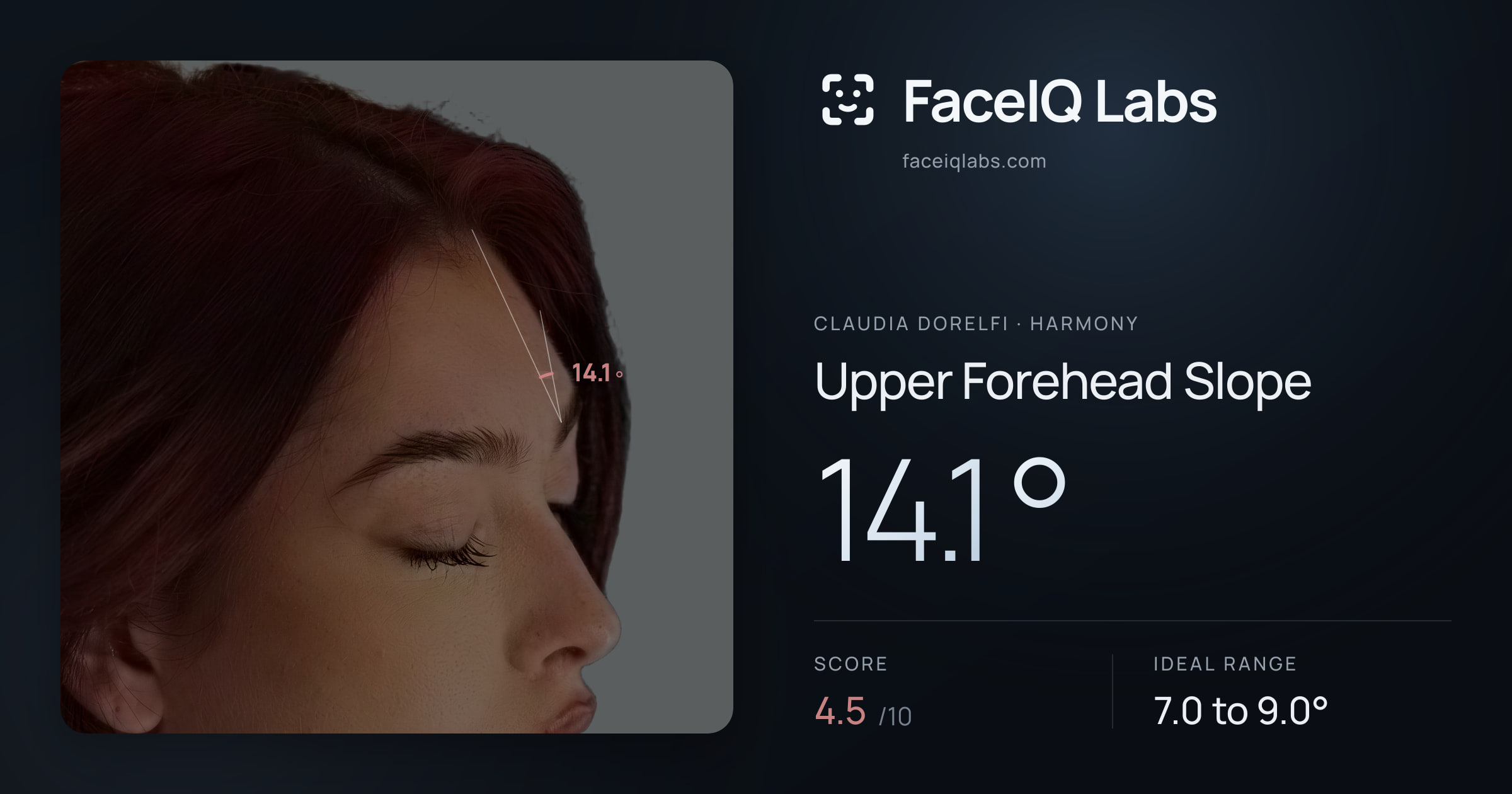 Claudia Dorelfi Upper Forehead Slope: 14.1°, drawn on the photo