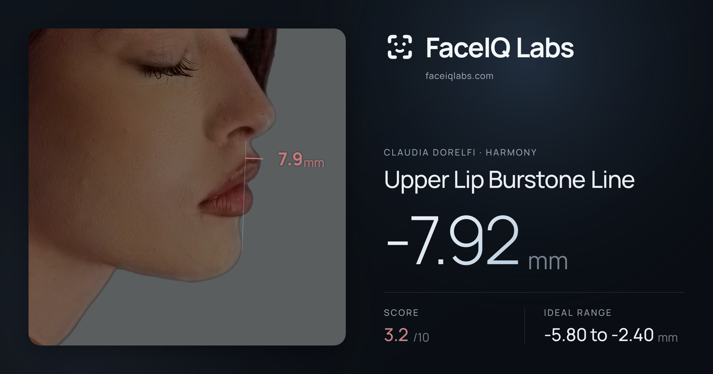 Claudia Dorelfi Upper Lip Burstone Line: -7.92mm, drawn on the photo