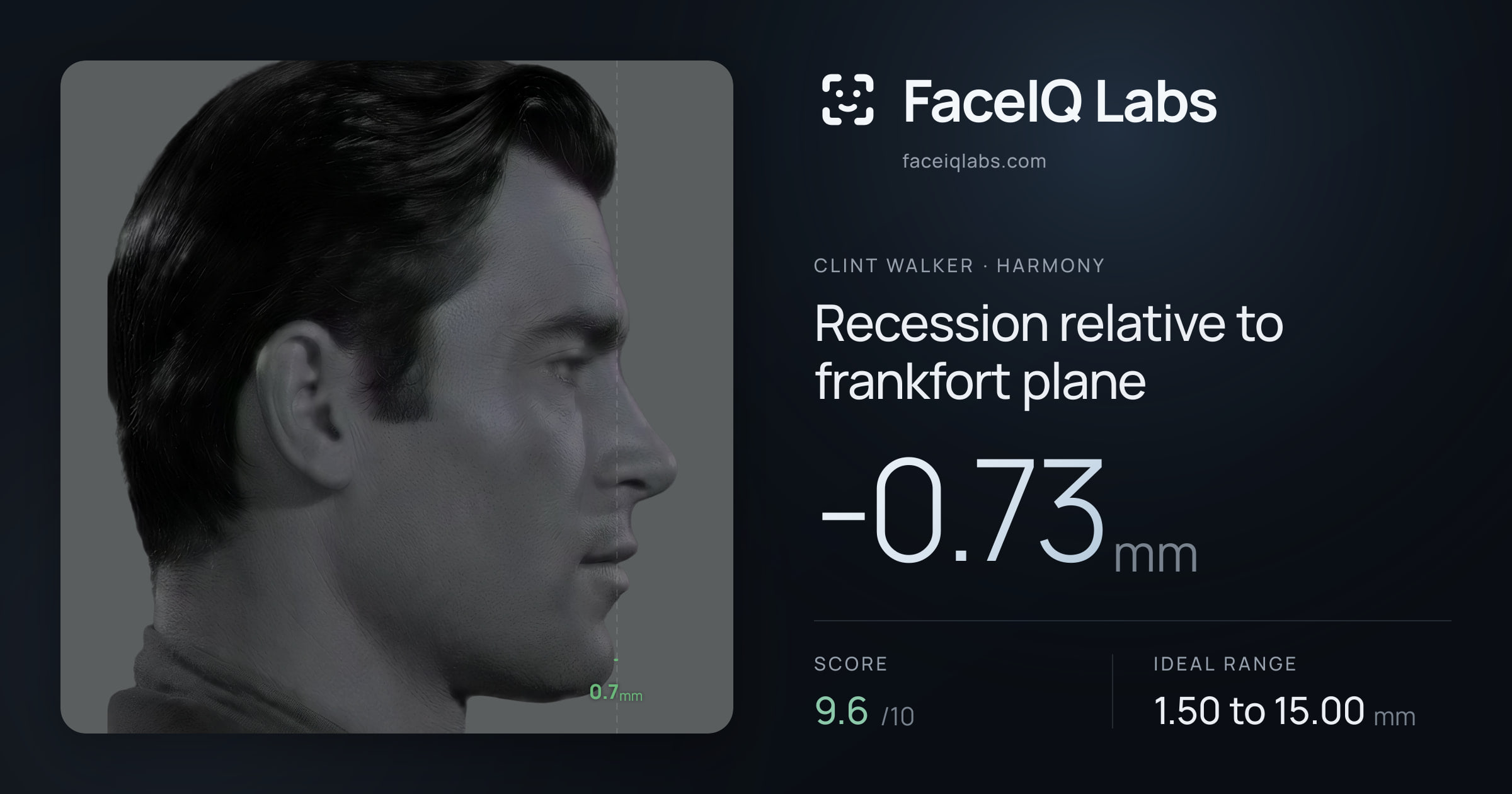 Clint Walker Recession relative to frankfort plane: -0.73mm, drawn on the photo