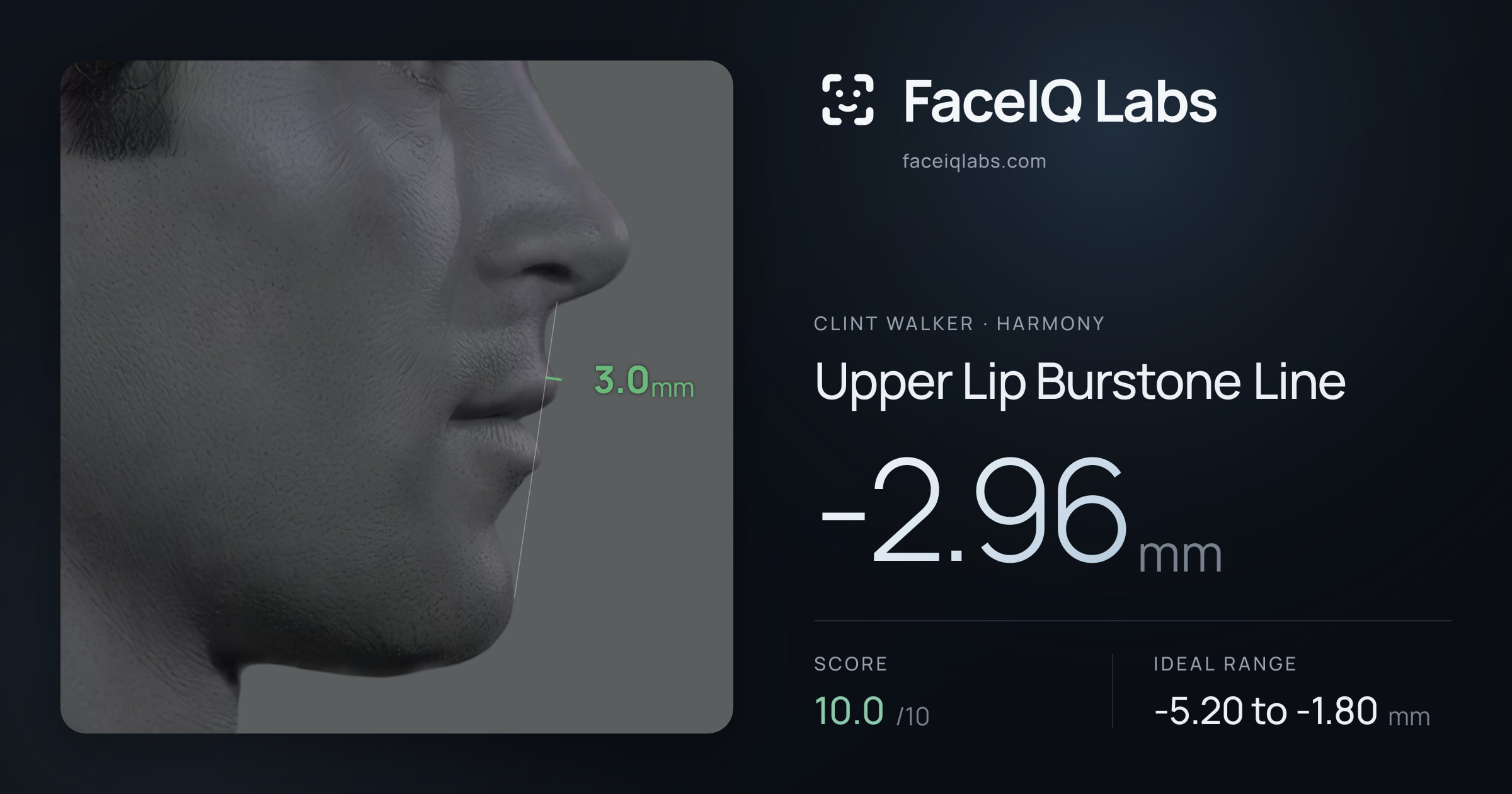 Clint Walker Upper Lip Burstone Line: -2.96mm, drawn on the photo