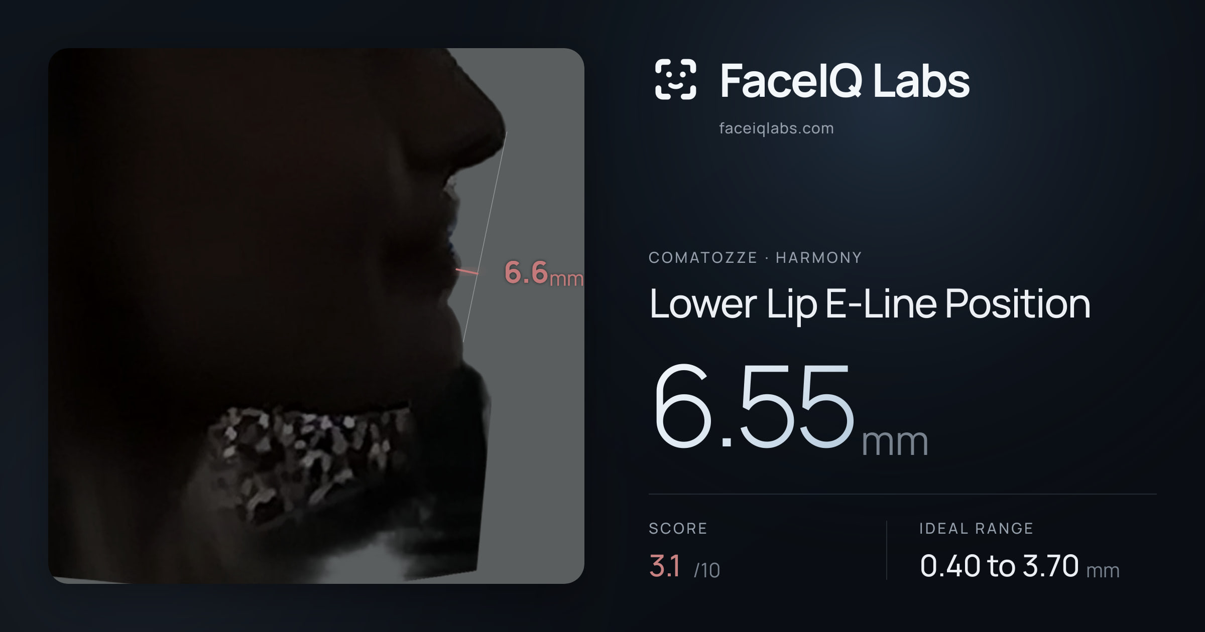 comatozze Lower Lip E-Line Position: 6.55mm, drawn on the photo