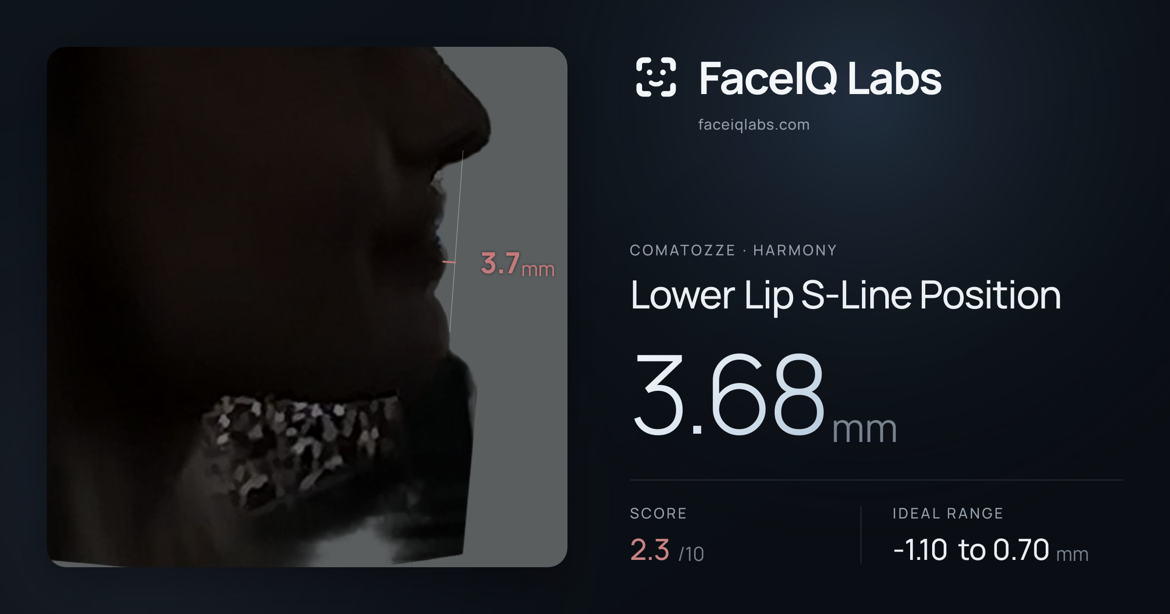Comatozze Lower Lip S-Line Position: 3.68mm, drawn on the photo