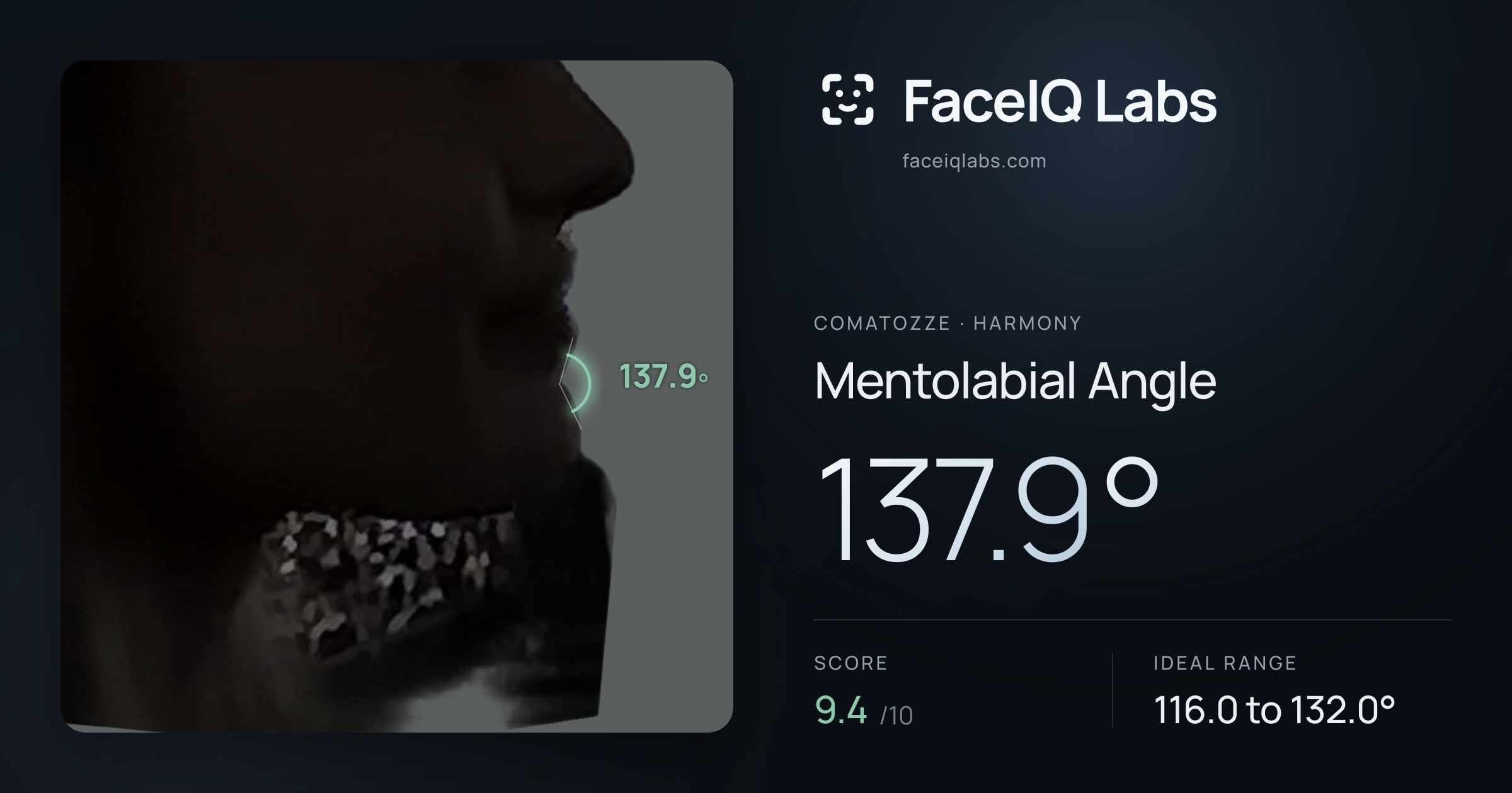 Comatozze Mentolabial Angle: 137.9°, drawn on the photo