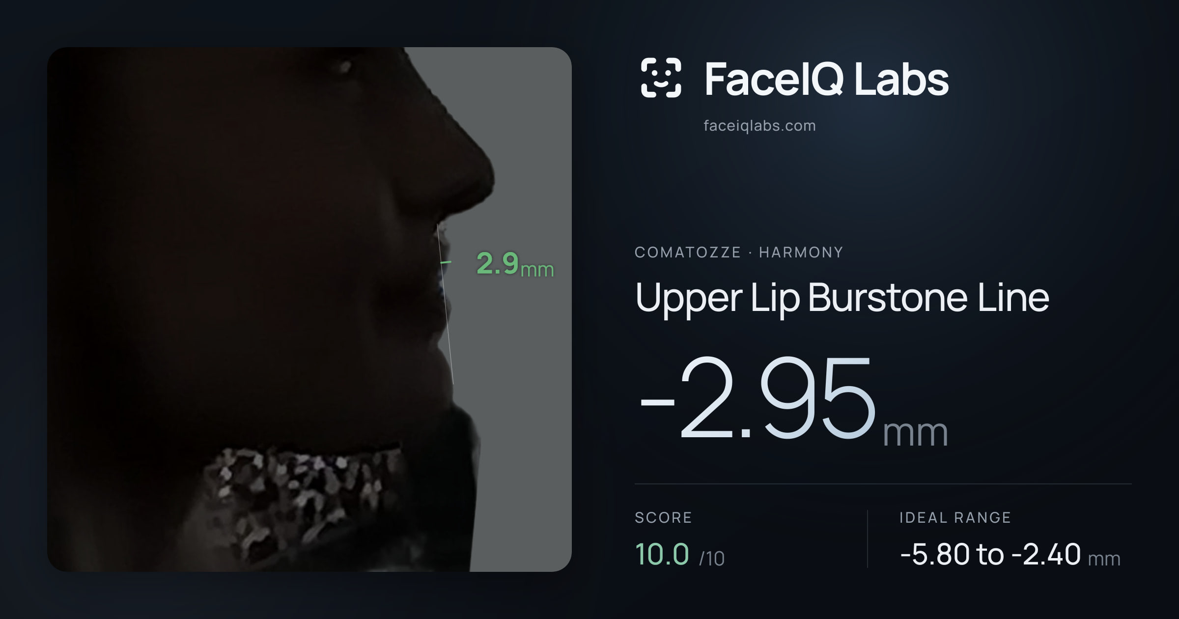 Comatozze Upper Lip Burstone Line: -2.95mm, drawn on the photo