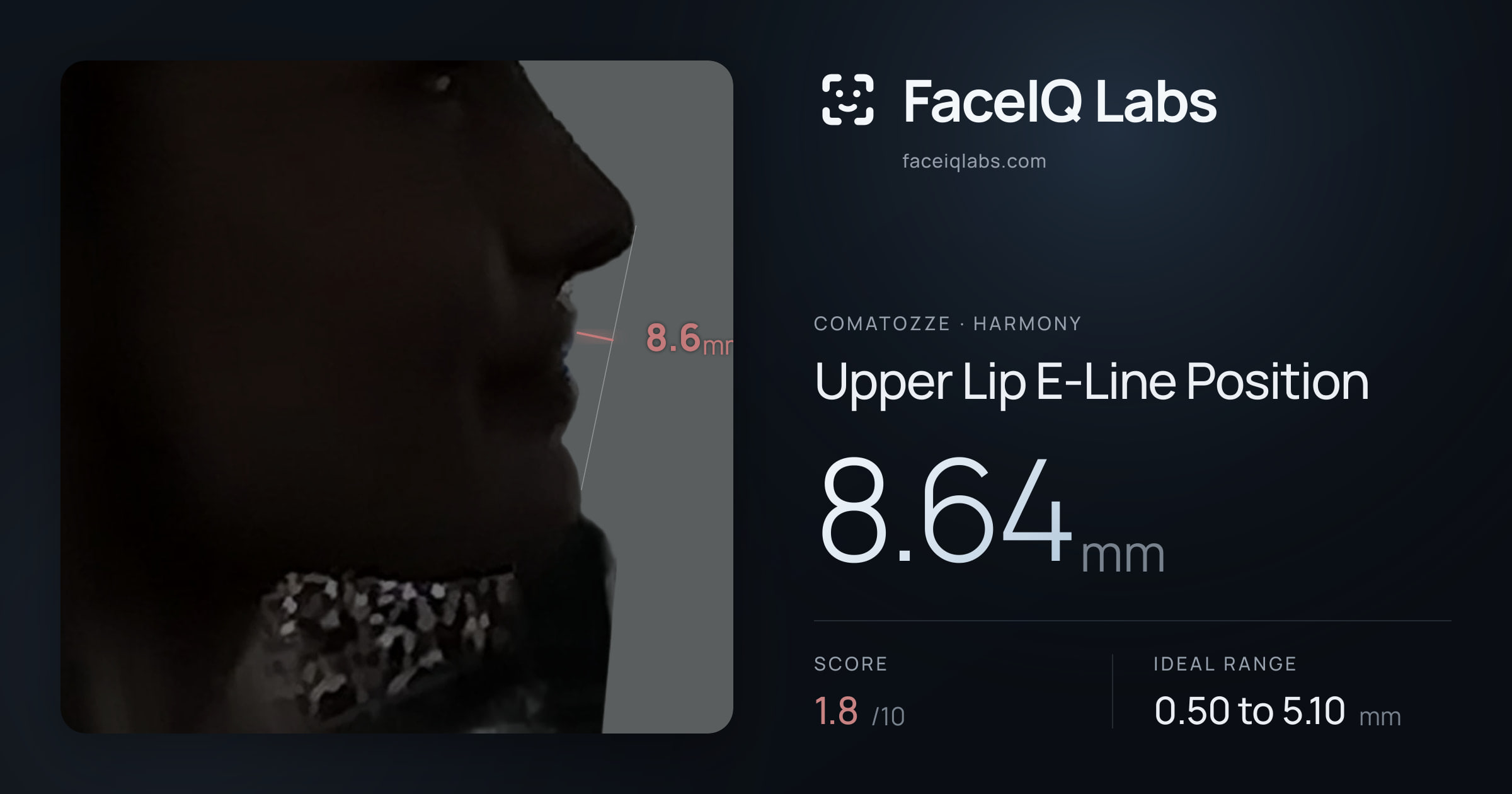 comatozze Upper Lip E-Line Position: 8.64mm, drawn on the photo